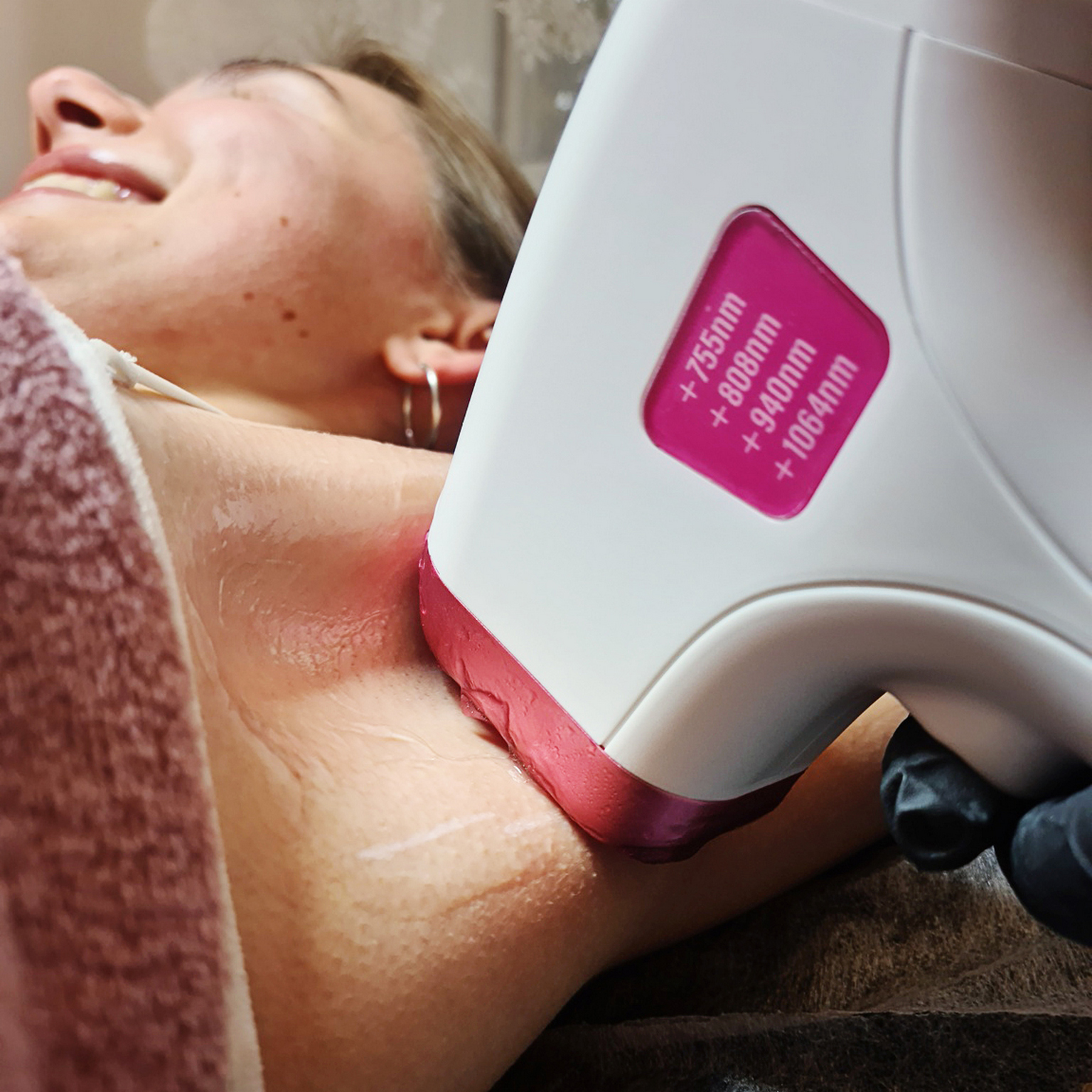 Depilacja Laserowa Efekty 4