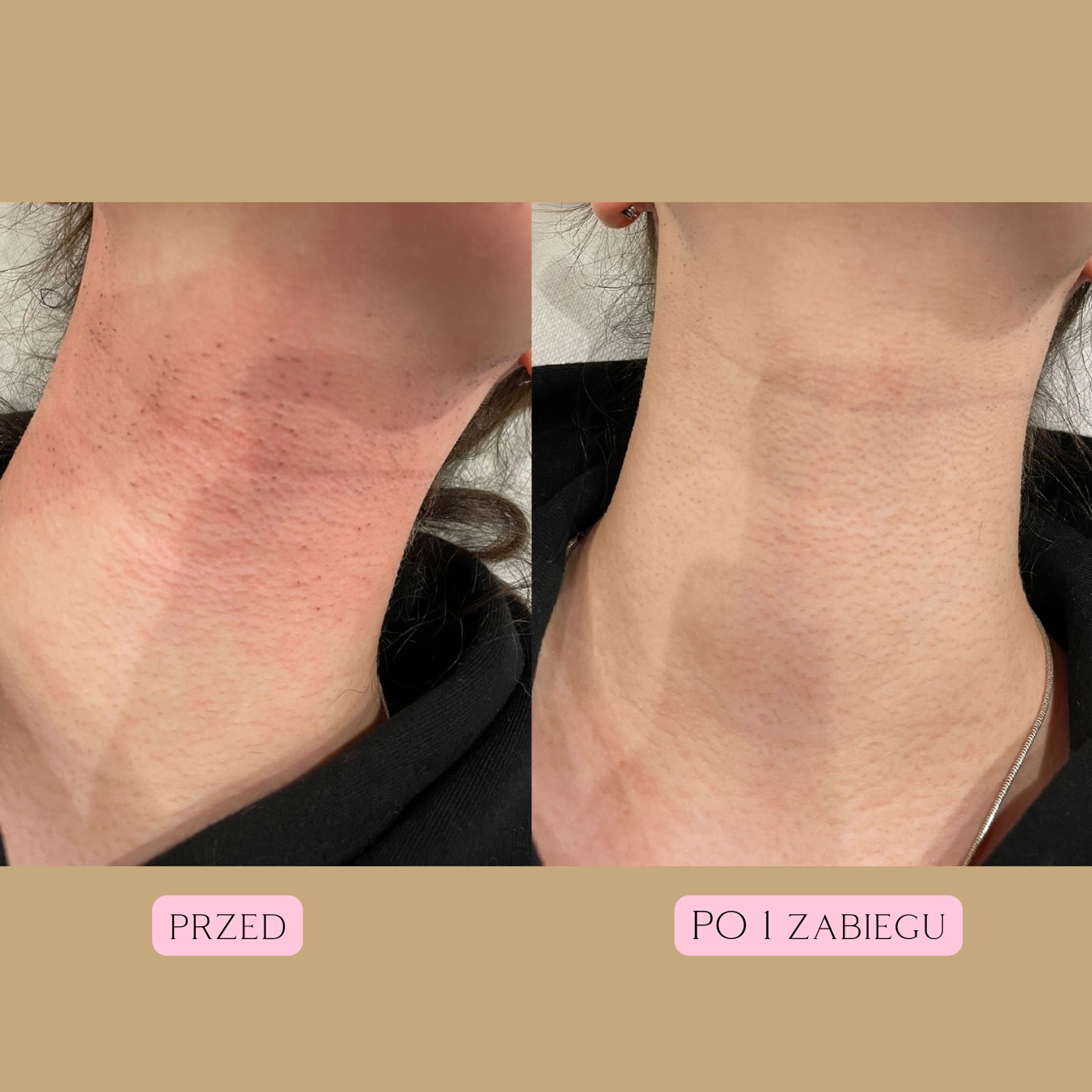 Depilacja Laserowa Efekty 16