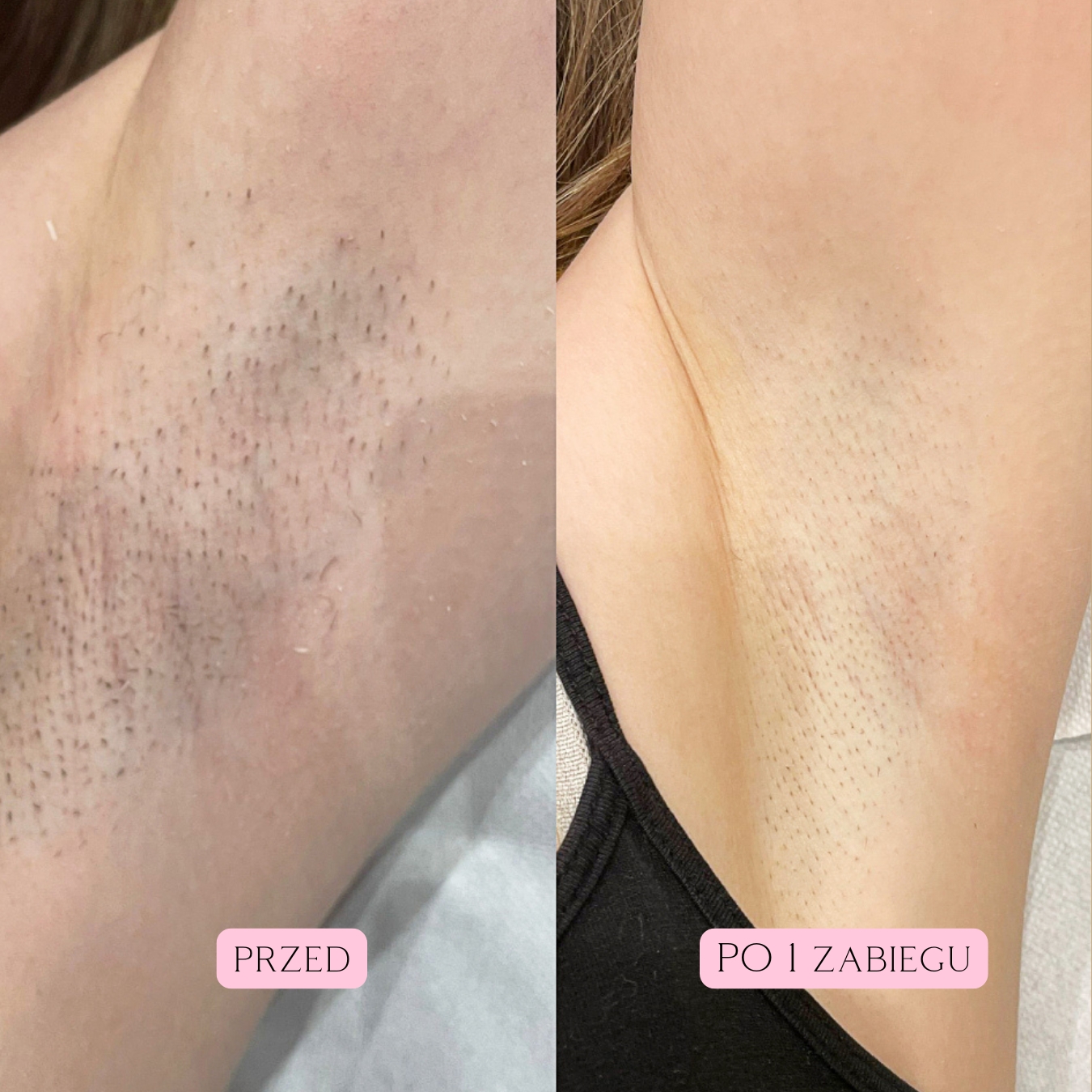 Depilacja Laserowa Efekty 17