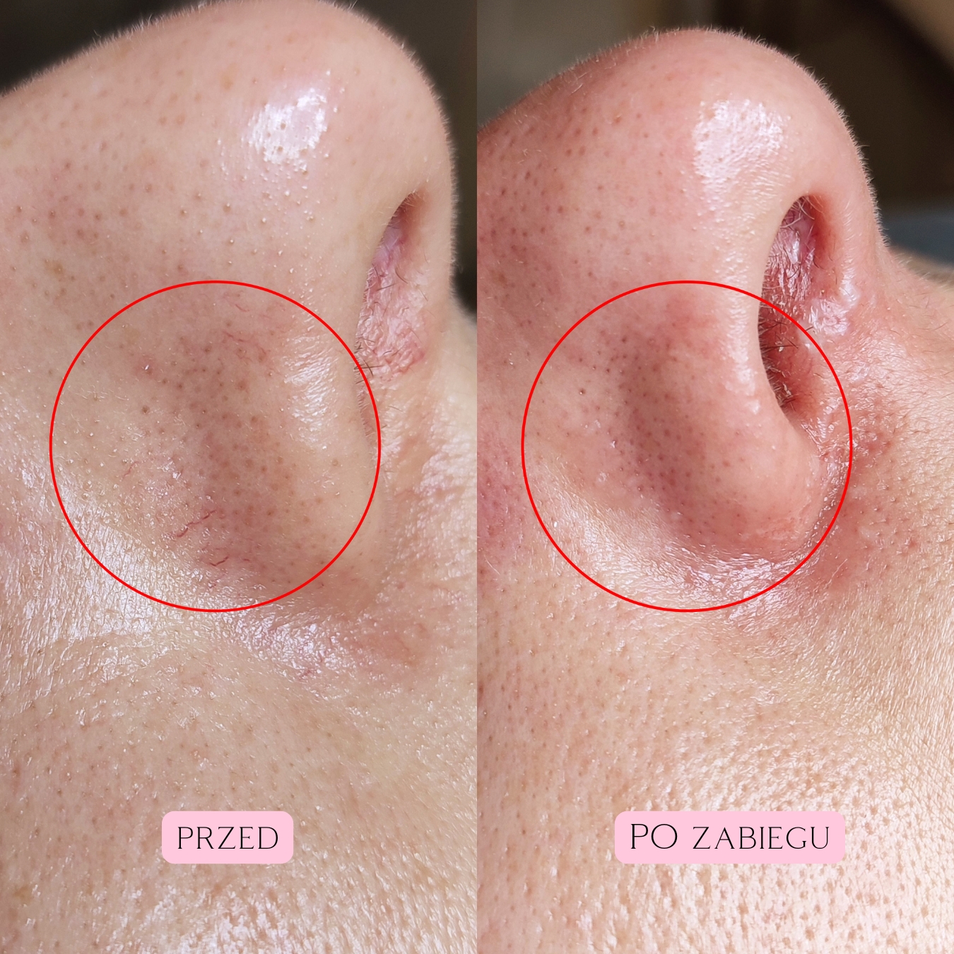 Laserowe zamykanie naczynek (11)