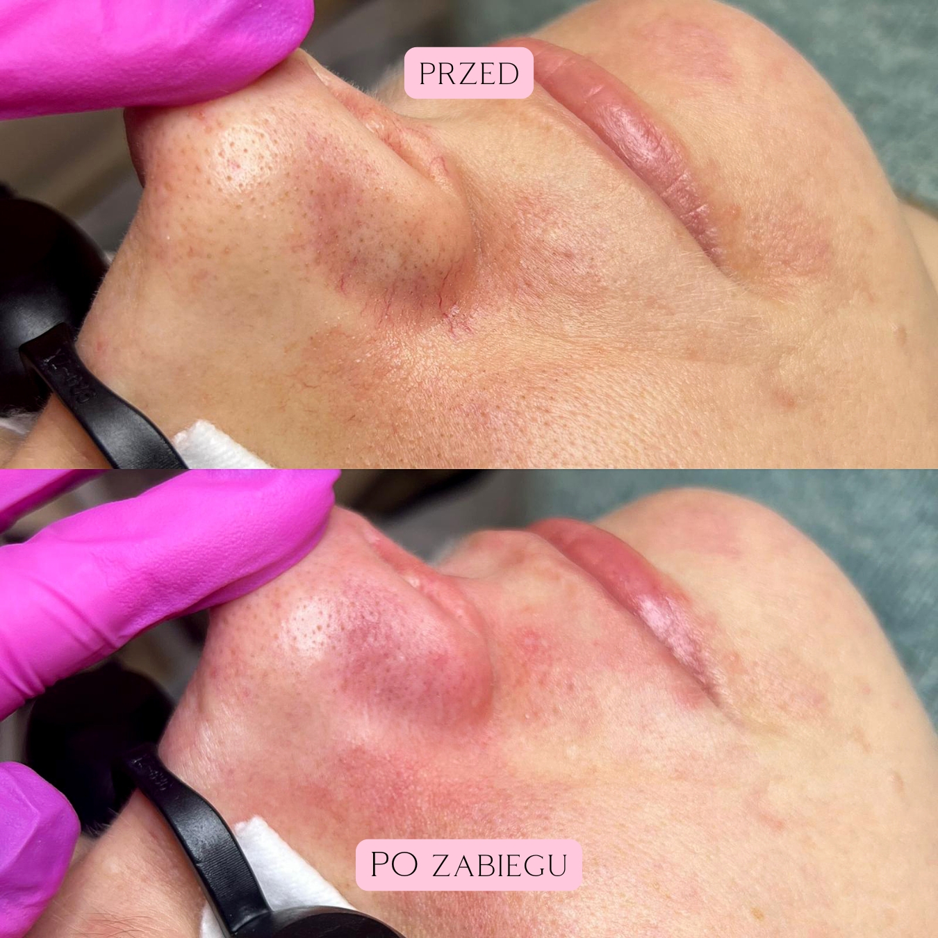 Laserowe zamykanie naczynek (12)