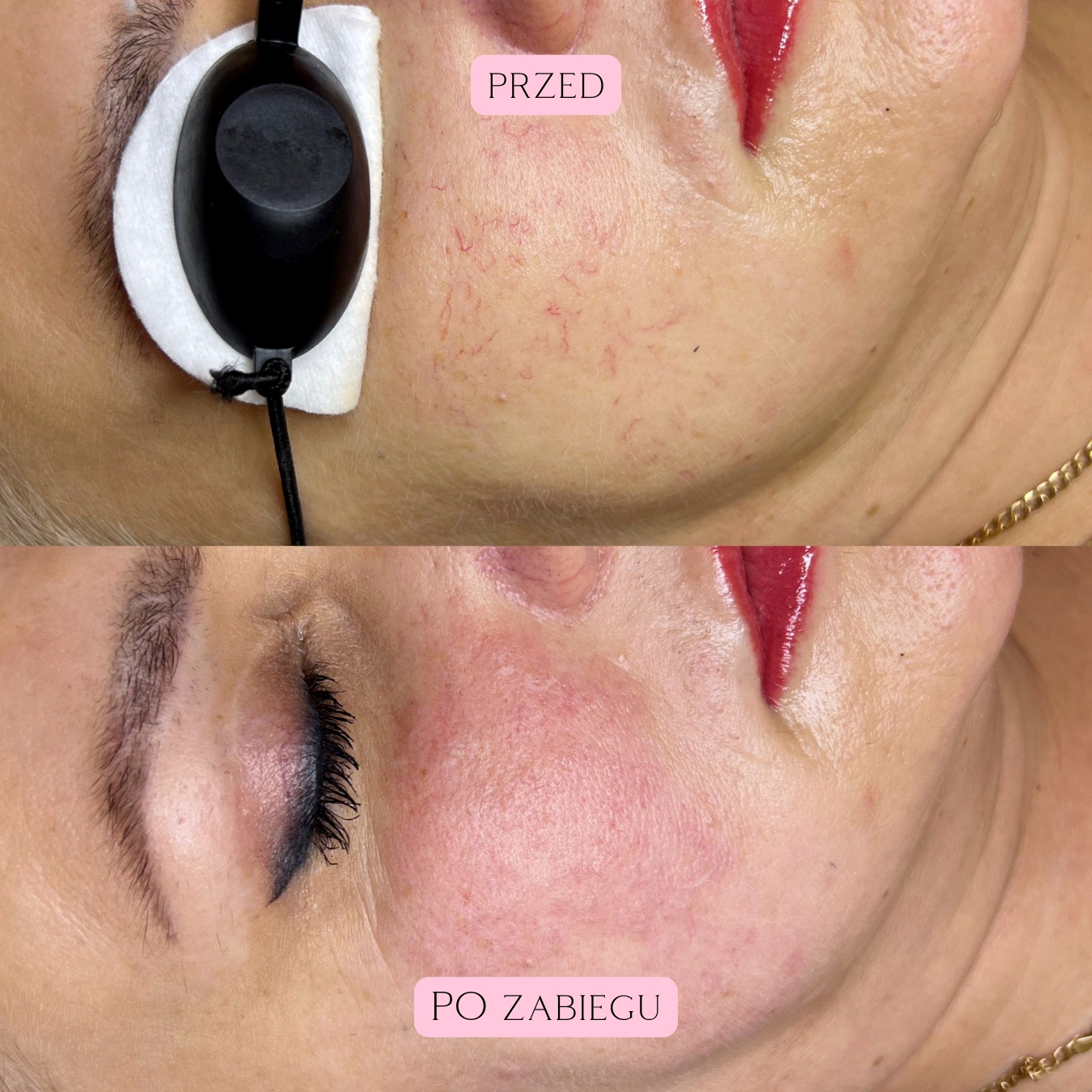 Laserowe zamykanie naczynek (13)