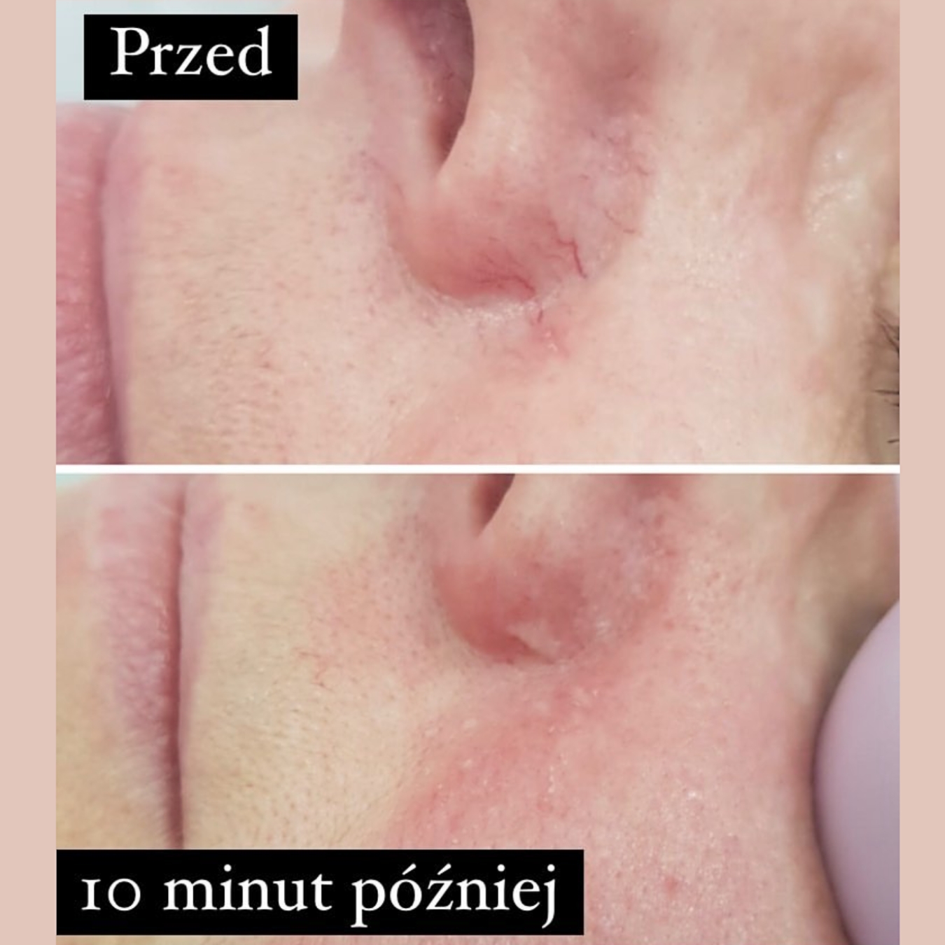 Laserowe zamykanie naczynek (18)