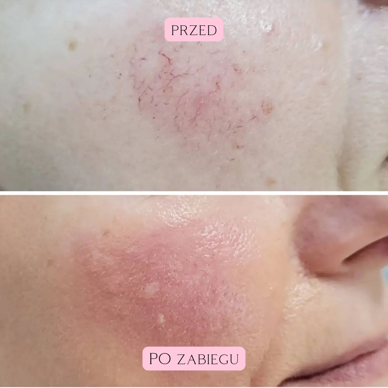 Laserowe zamykanie naczynek (19)