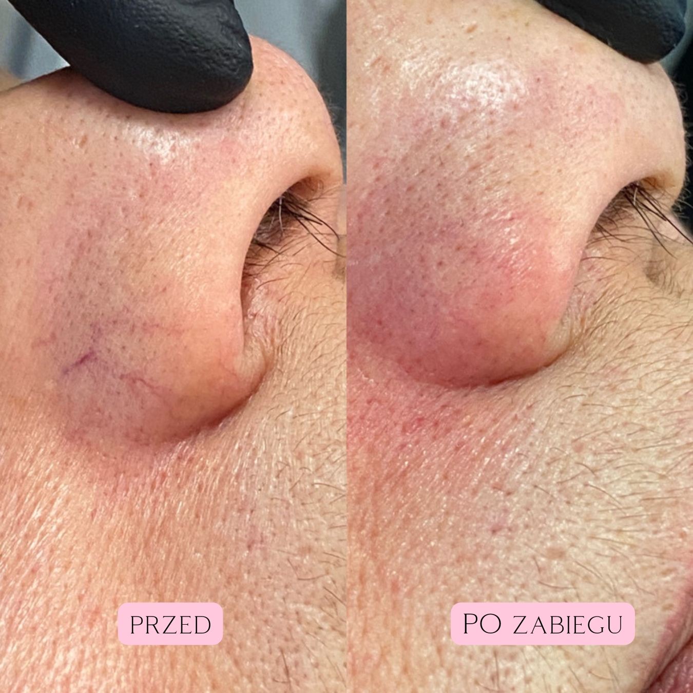 Laserowe zamykanie naczynek (20)