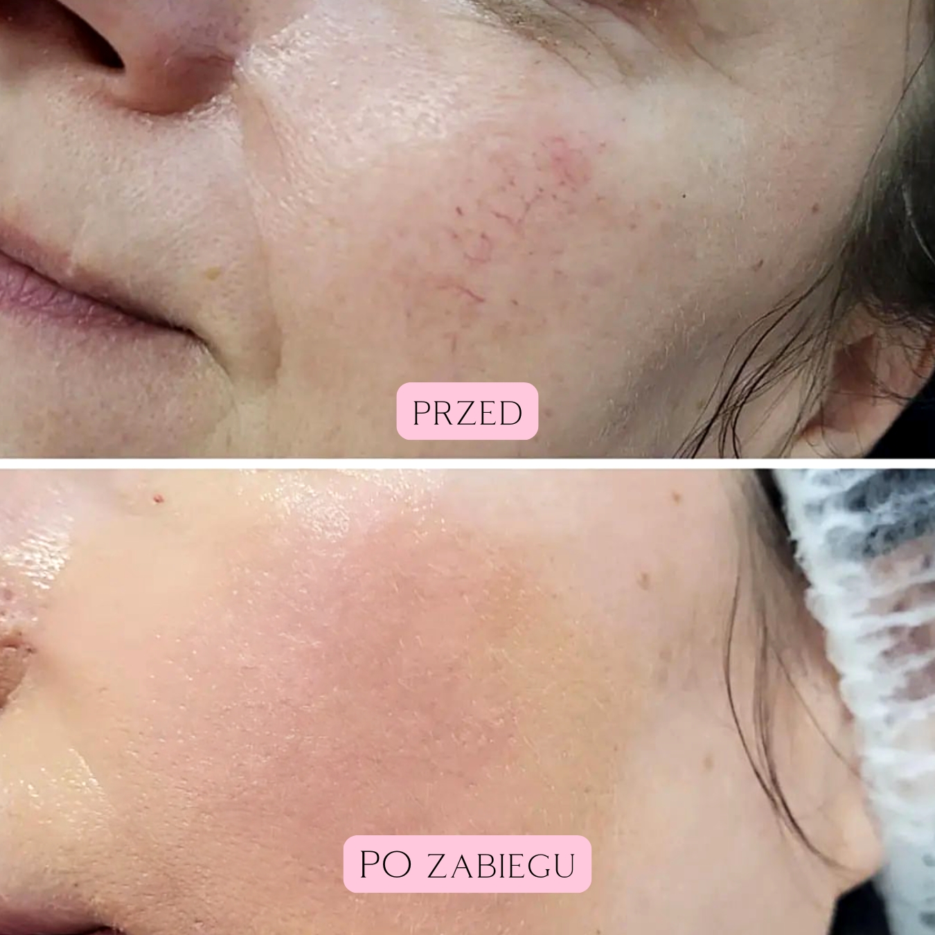 Laserowe zamykanie naczynek (21)