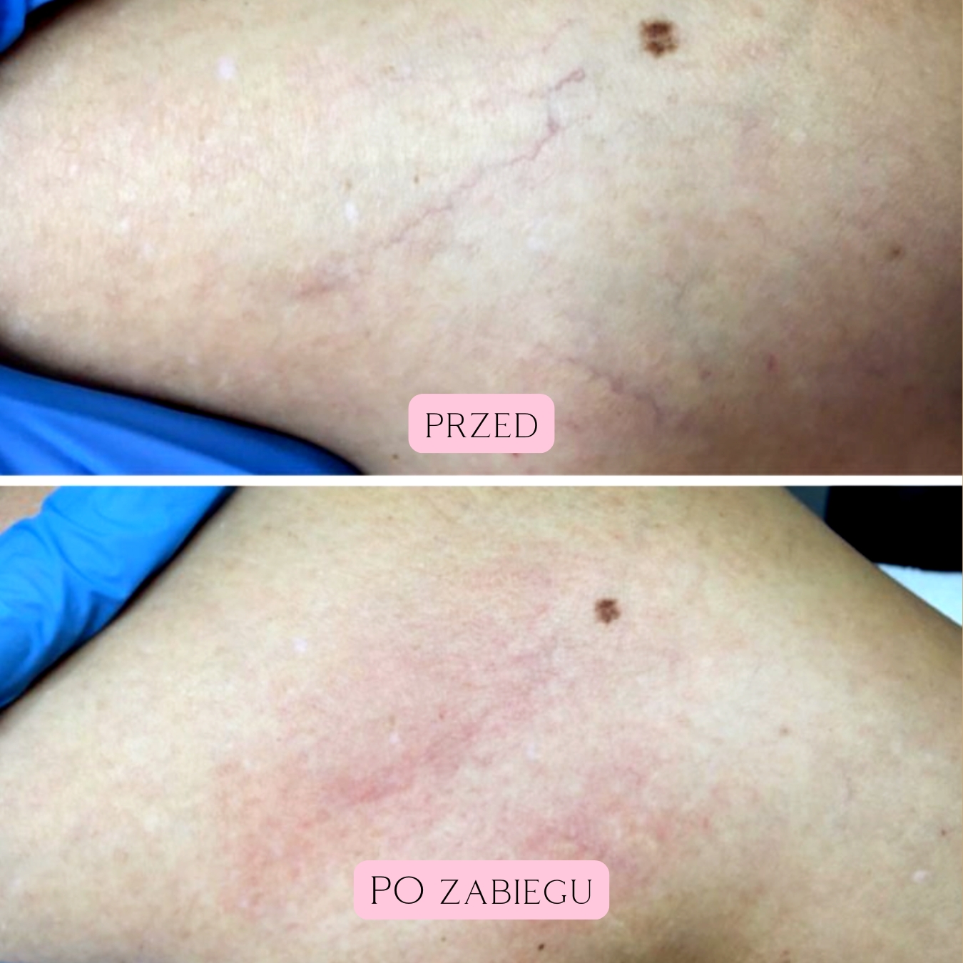 Laserowe zamykanie naczynek (22)