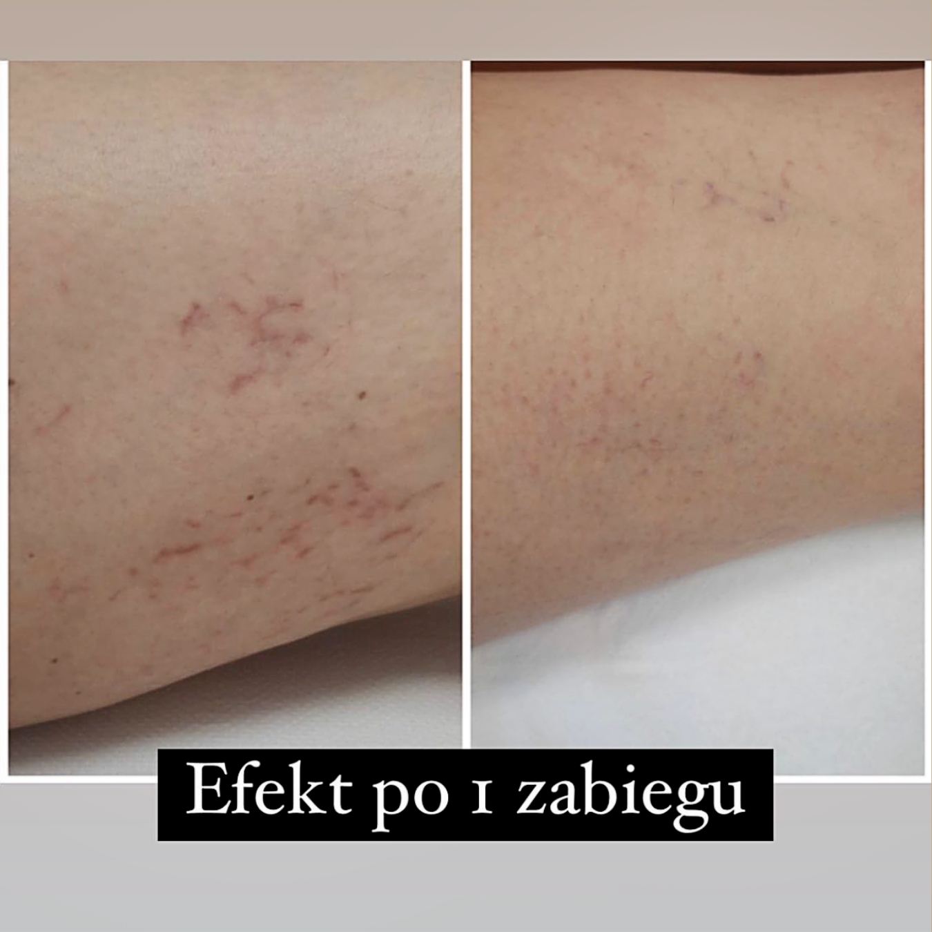 Laserowe zamykanie naczynek (23)