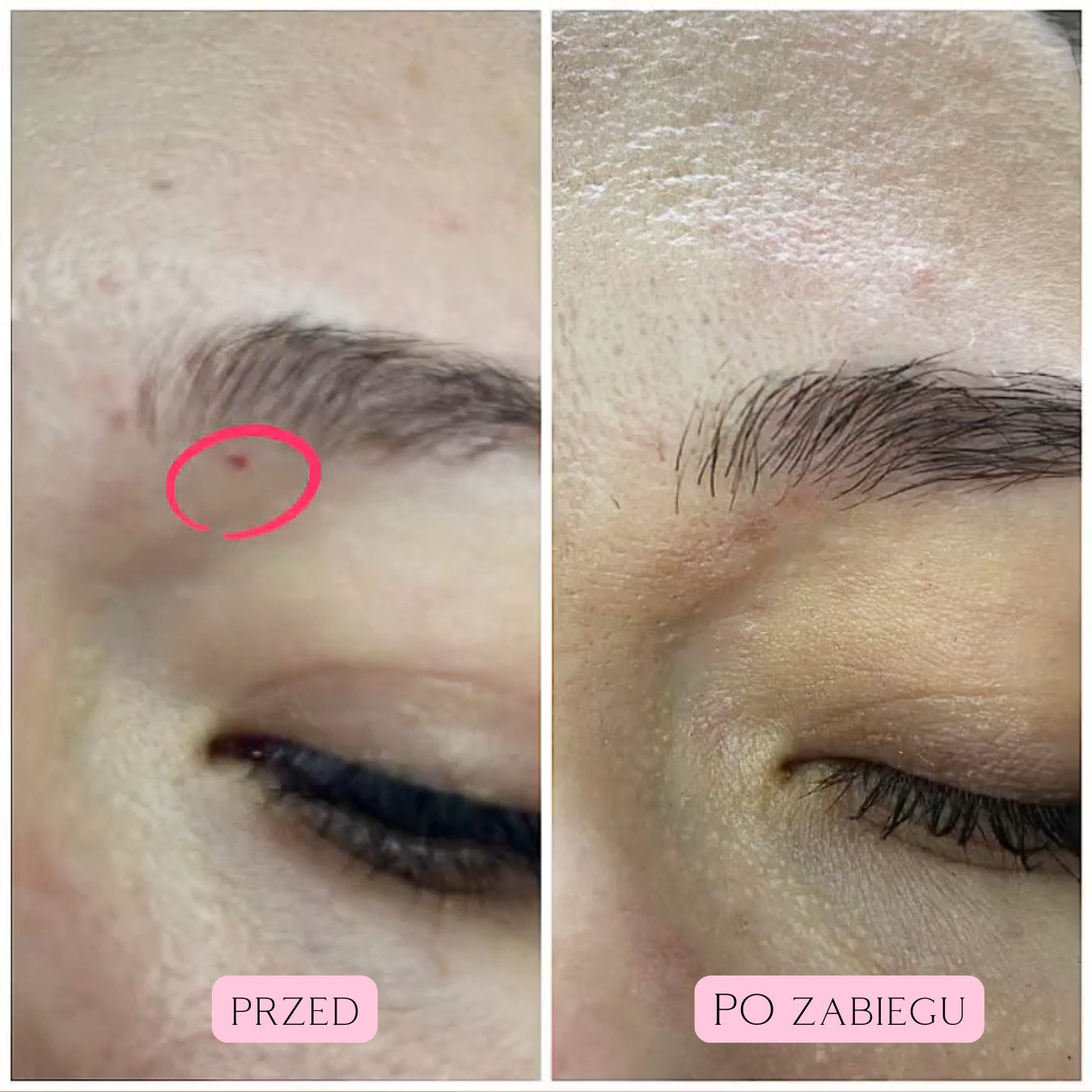 Laserowe zamykanie włókniaków i rubiniaków (2)