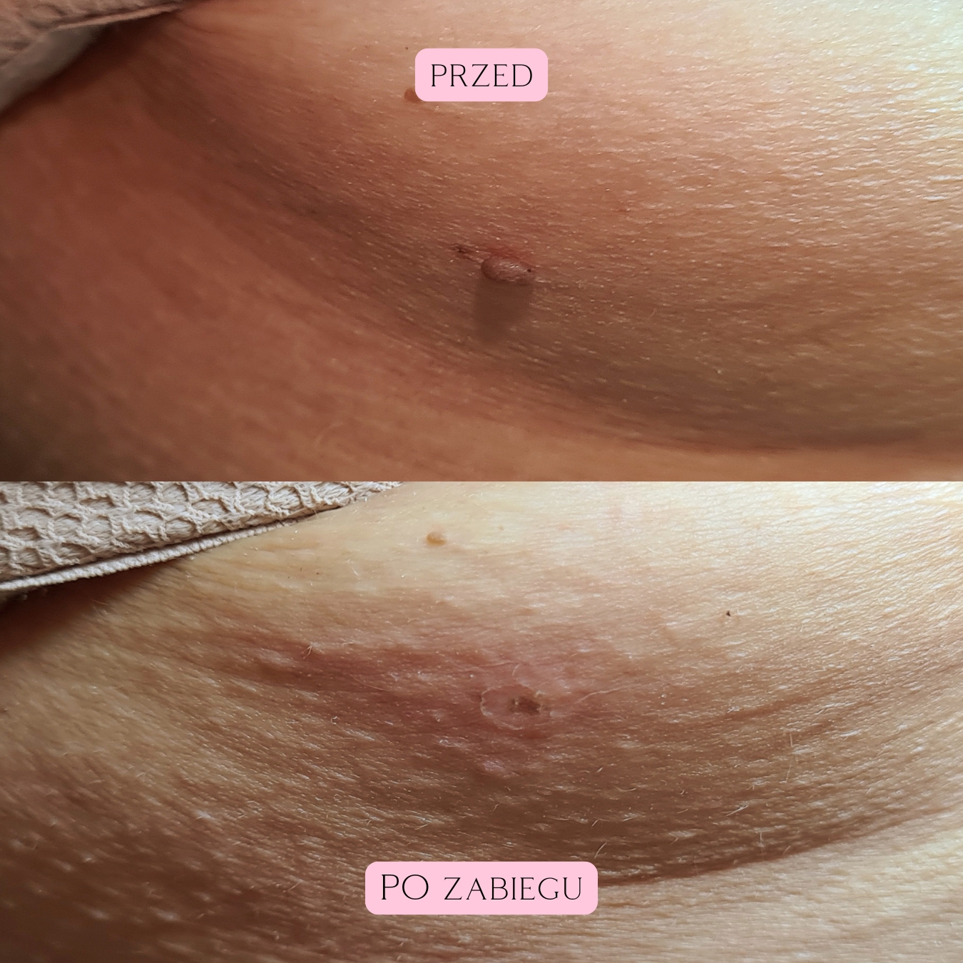 Laserowe zamykanie włókniaków i rubiniaków (3)