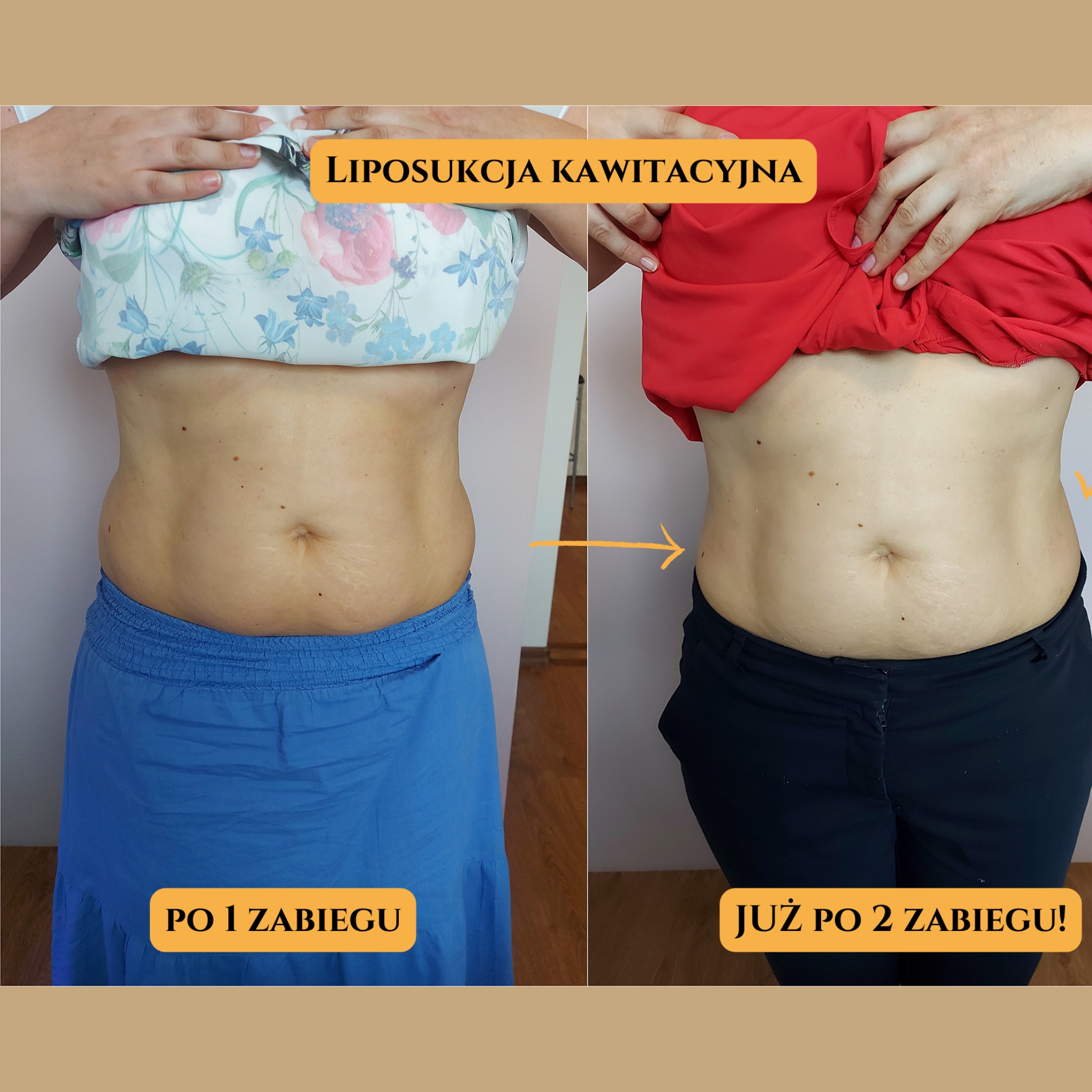 Liposukcja kawitacyjna Efekty 10