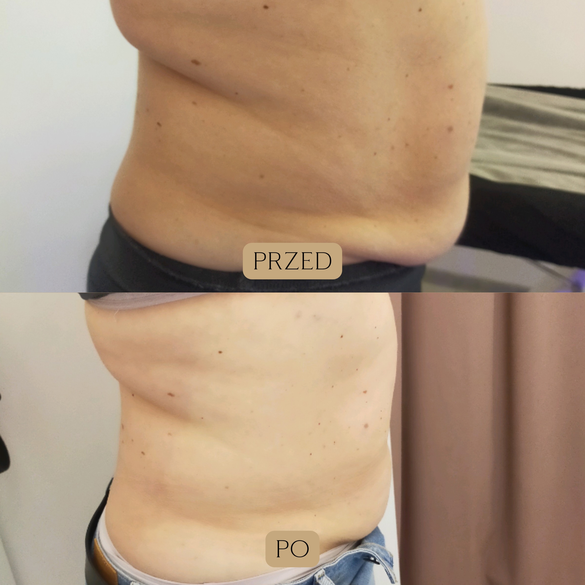 Liposukcja kawitacyjna Efekty 11