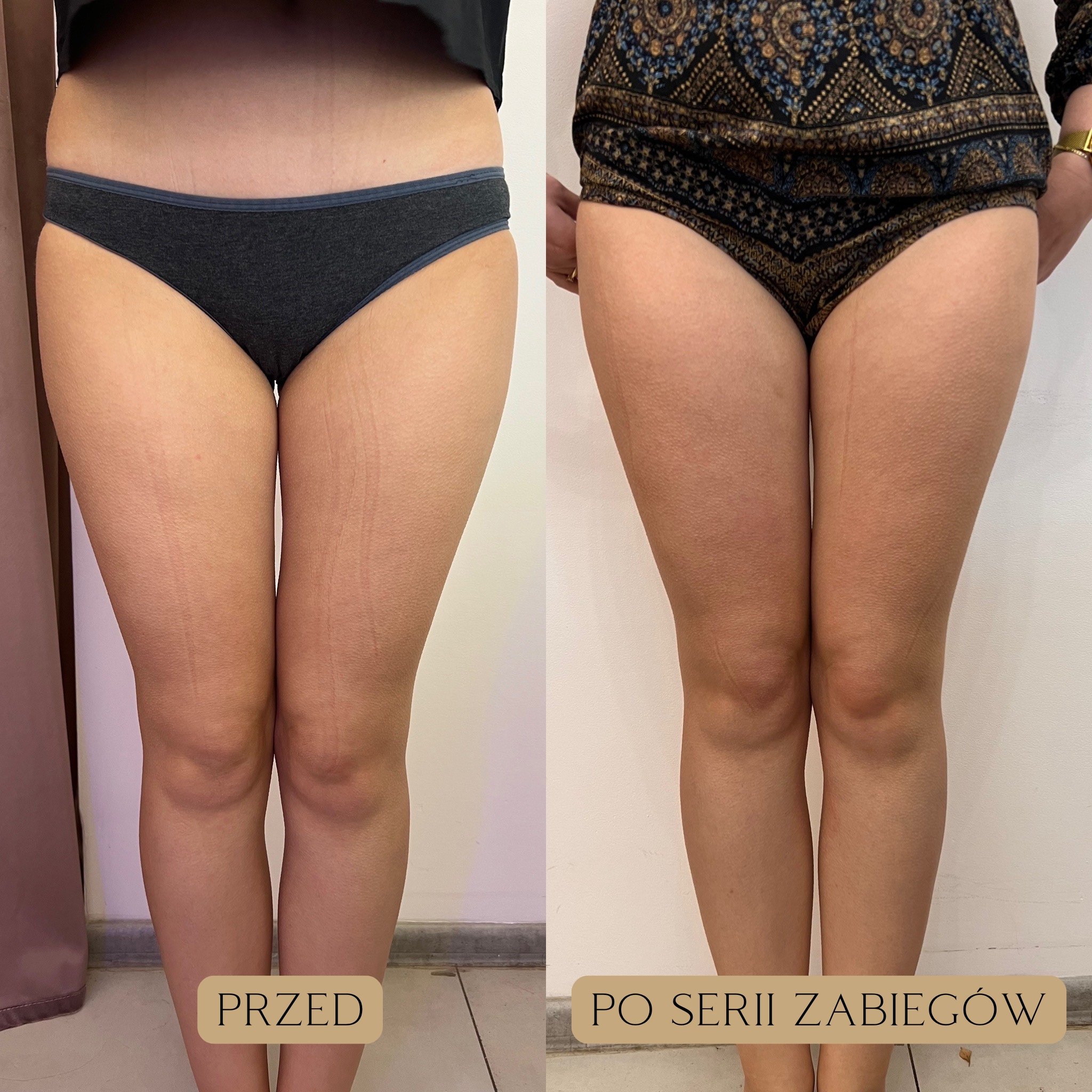 Liposukcja kawitacyjna Efekty 12