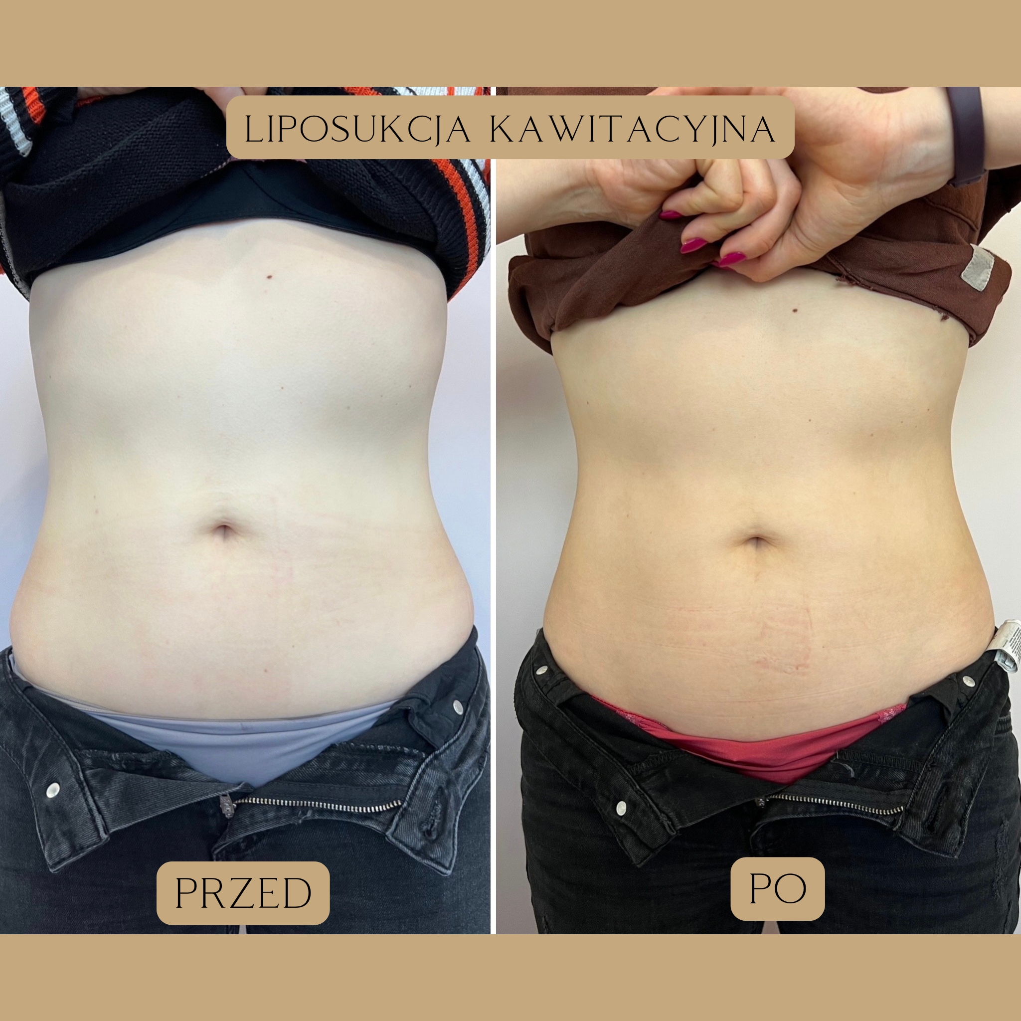 Liposukcja kawitacyjna Efekty 13