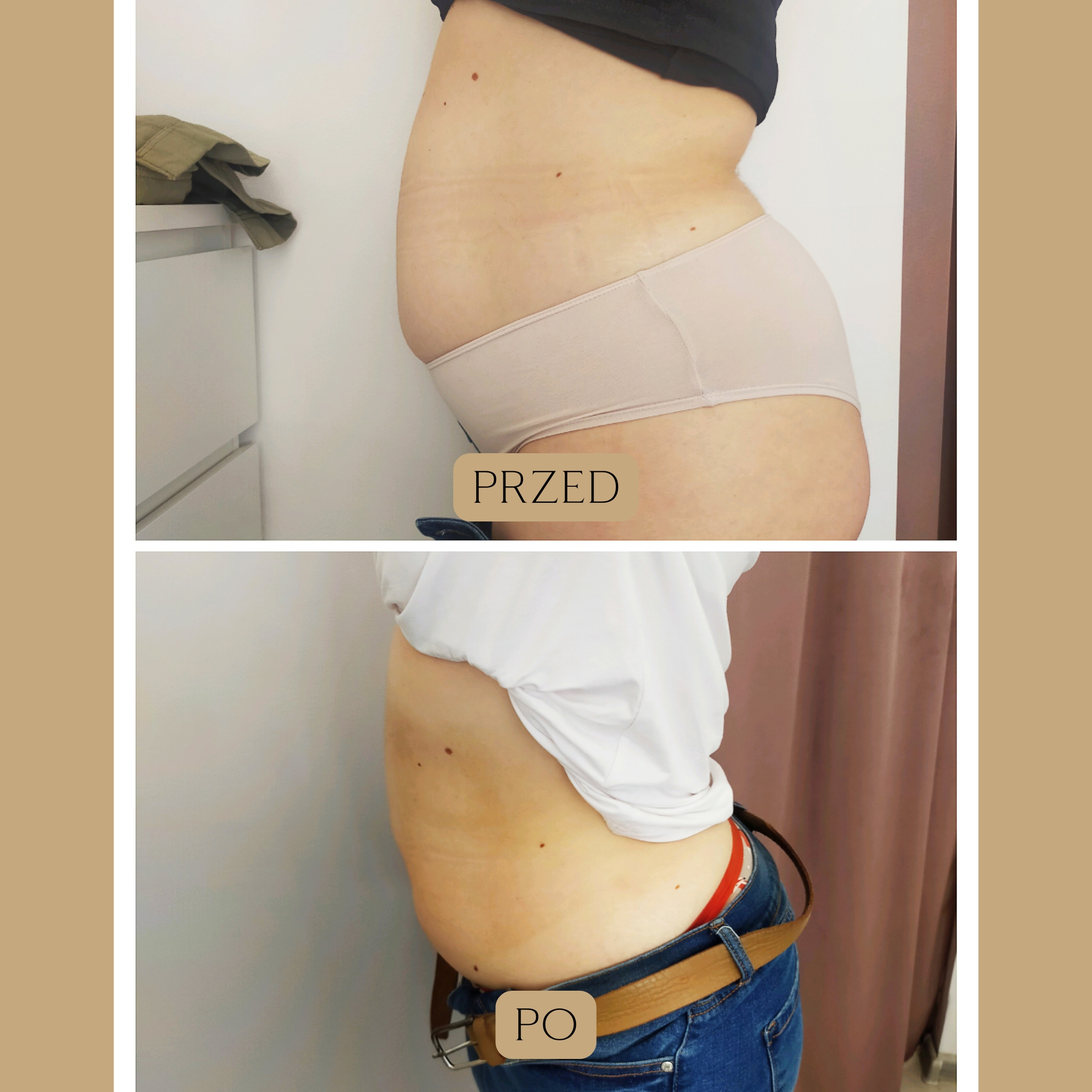 Liposukcja kawitacyjna Efekty 2