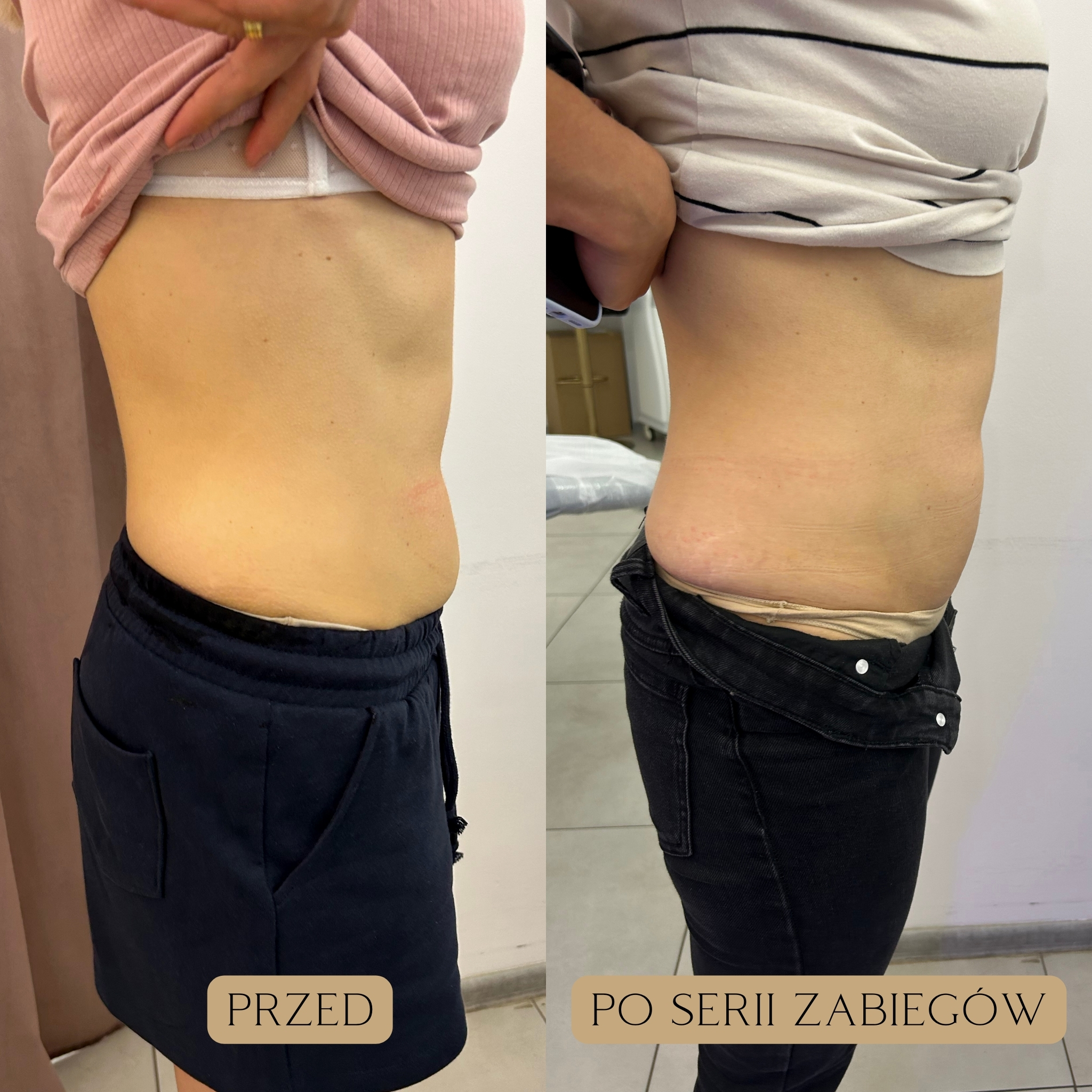 Liposukcja kawitacyjna Efekty 5