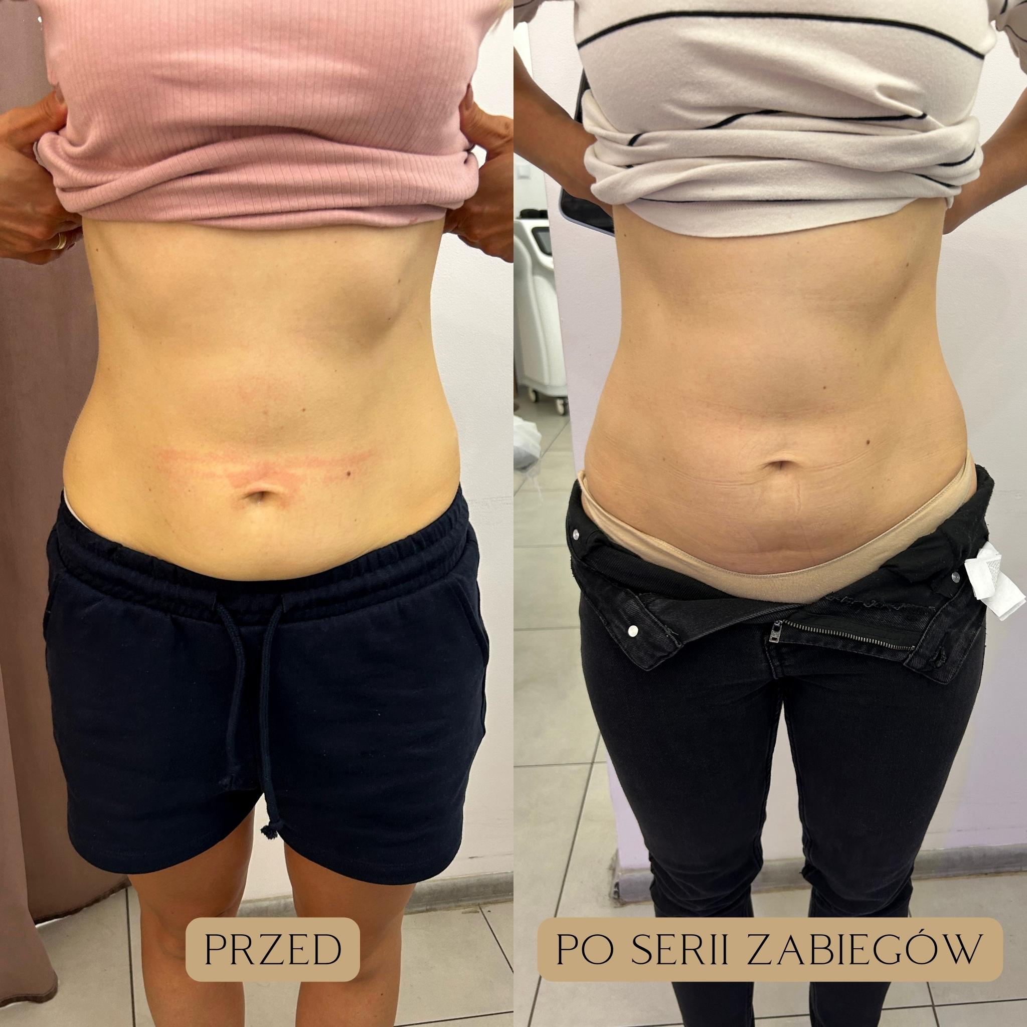 Liposukcja kawitacyjna Efekty 6