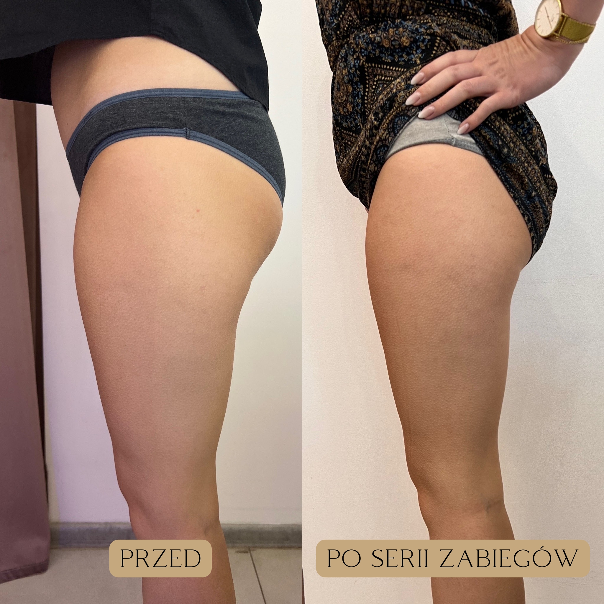 Liposukcja kawitacyjna Efekty 8