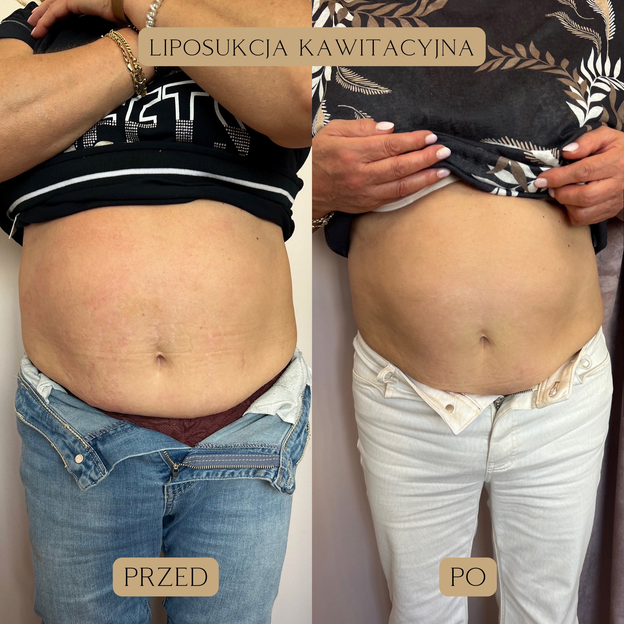 Liposukcja kawitacyjna Efekty 9