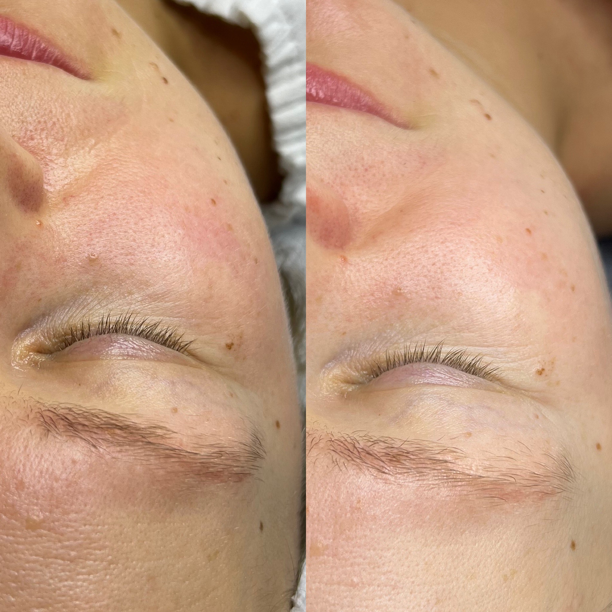 Mezoterapia Igłowa Efekty 1