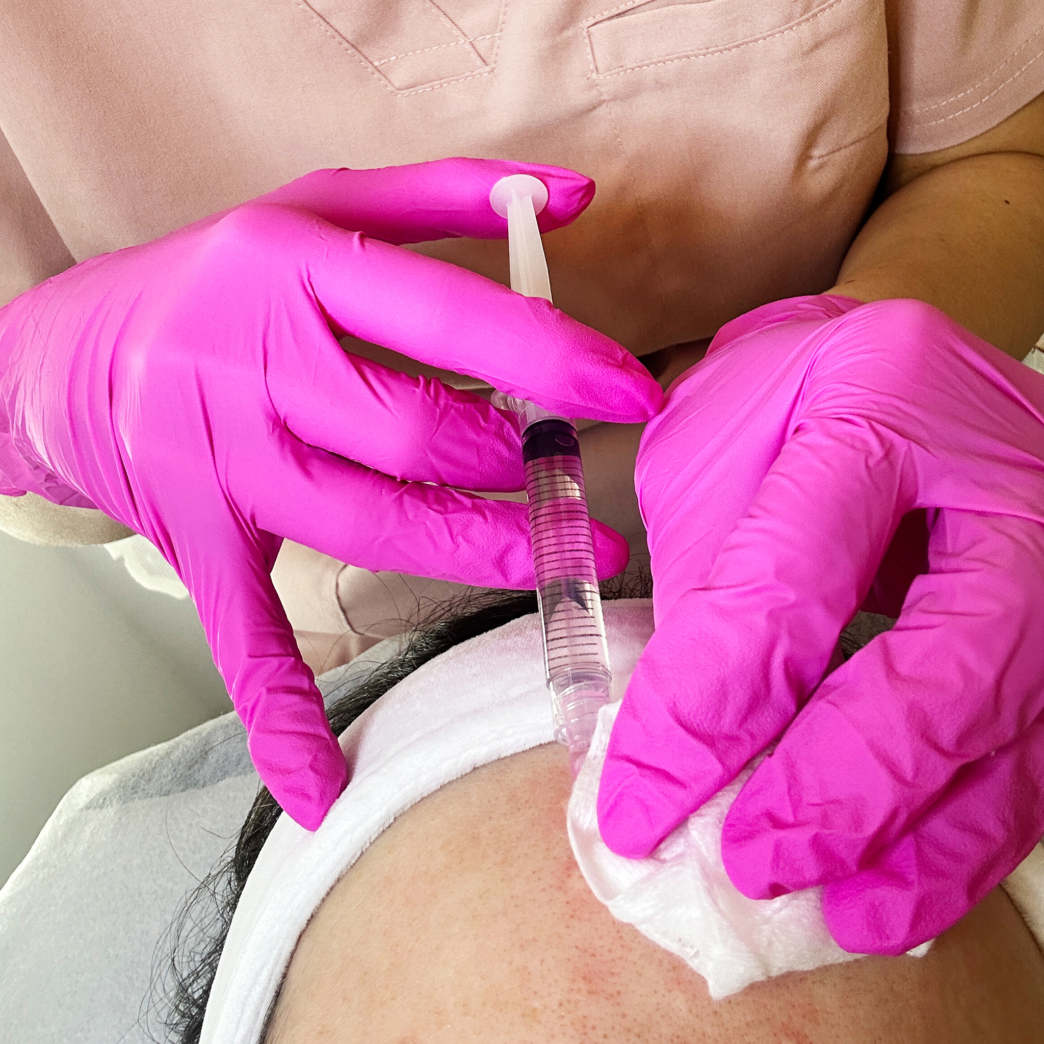 Mezoterapia Igłowa Efekty 4