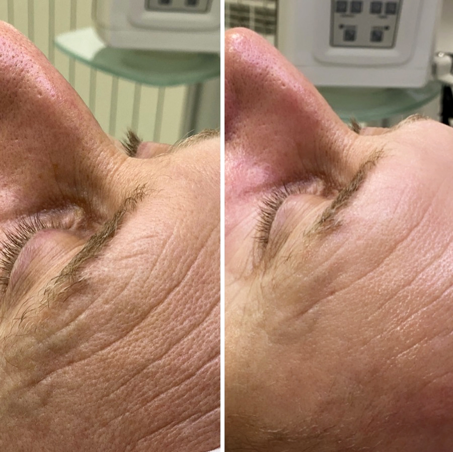 Mezoterapia Igłowa Efekty 5