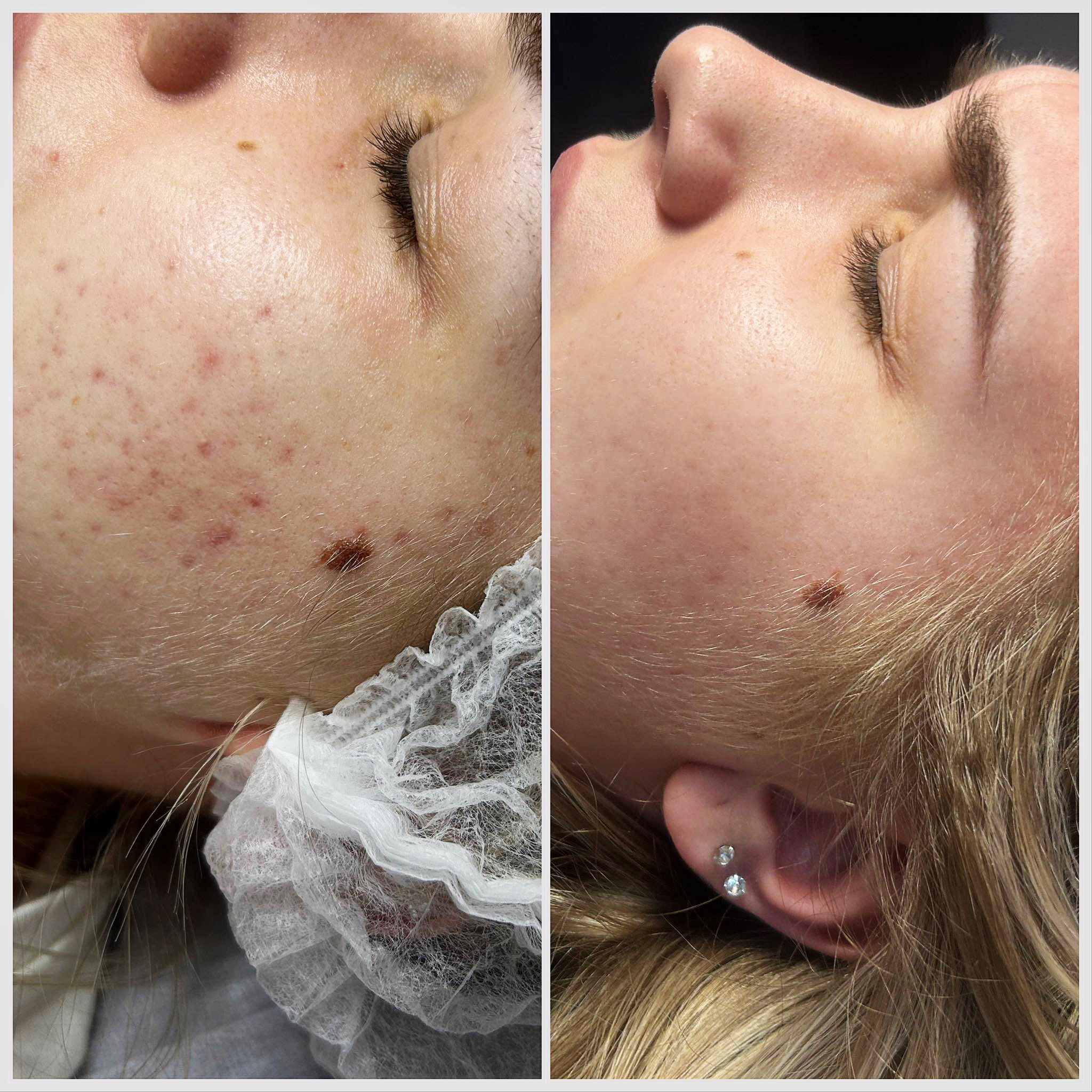 Mezoterapia Mikroigłowa Efekty 1