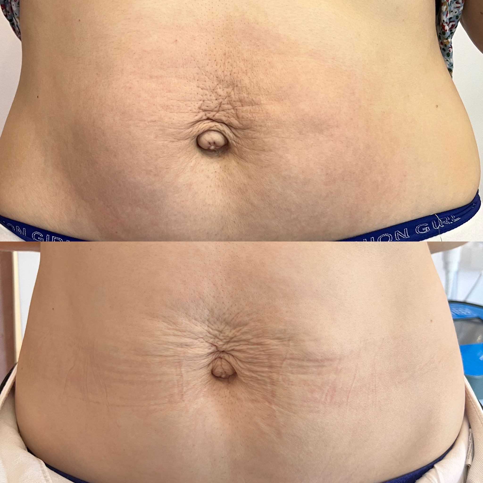 Mezoterapia Mikroigłowa Efekty 10