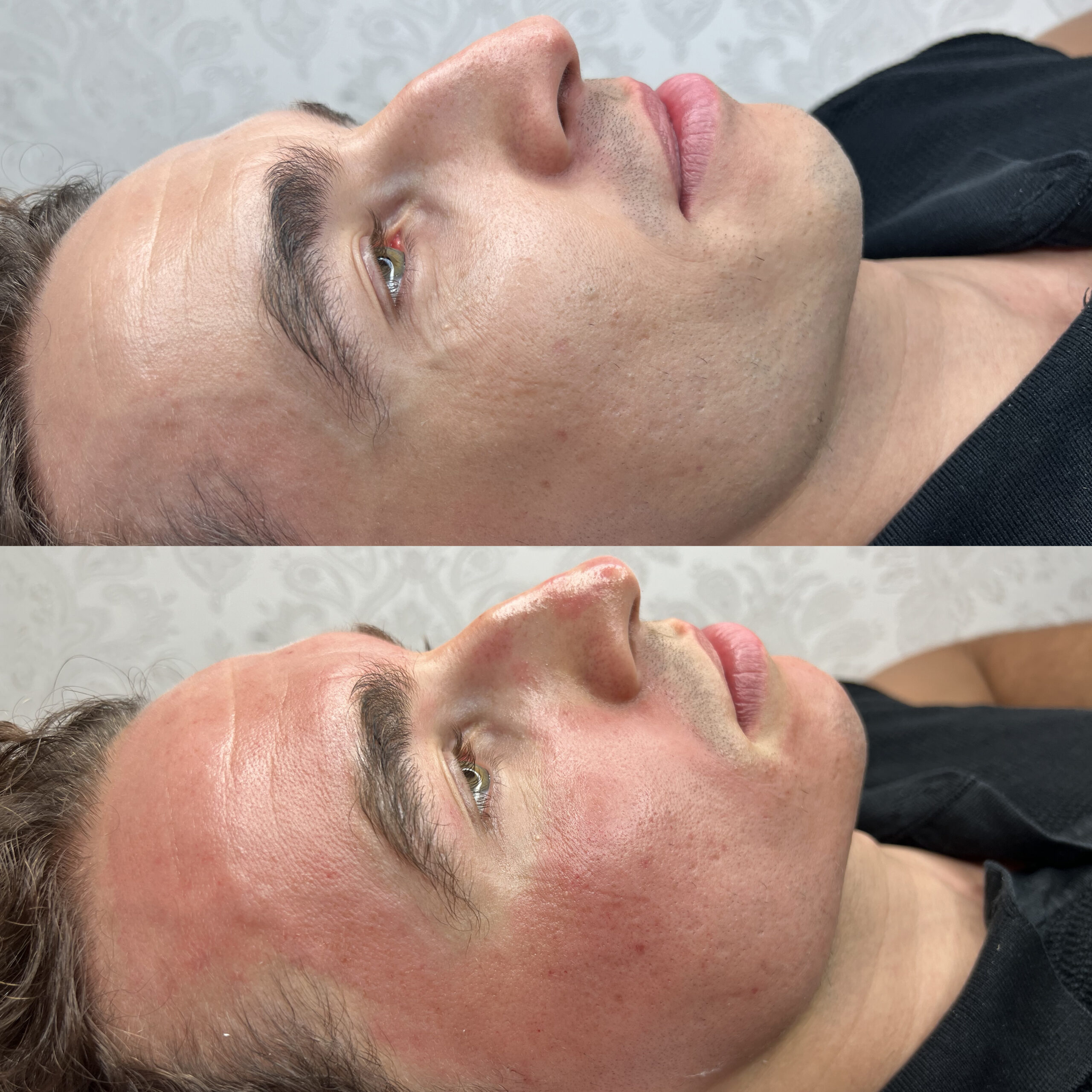 Mezoterapia Mikroigłowa Efekty 6