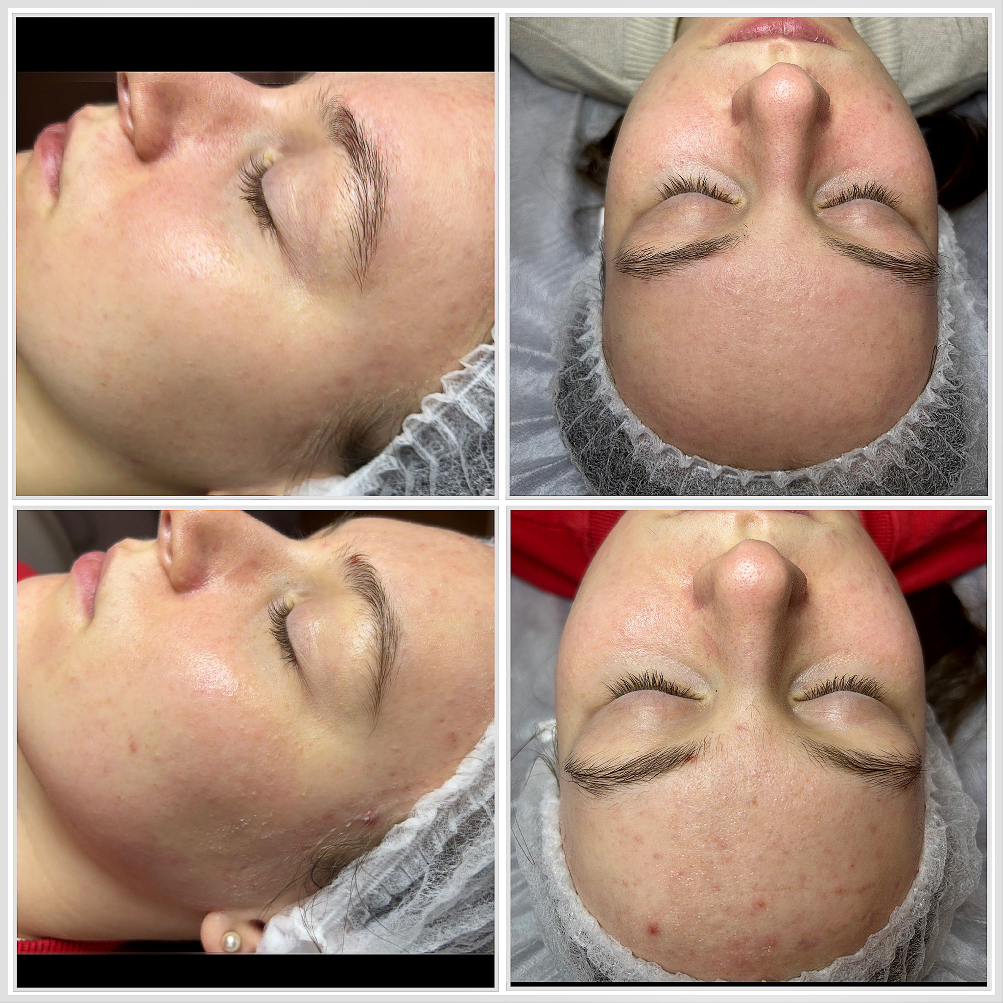 Mezoterapia Mikroigłowa Efekty 7