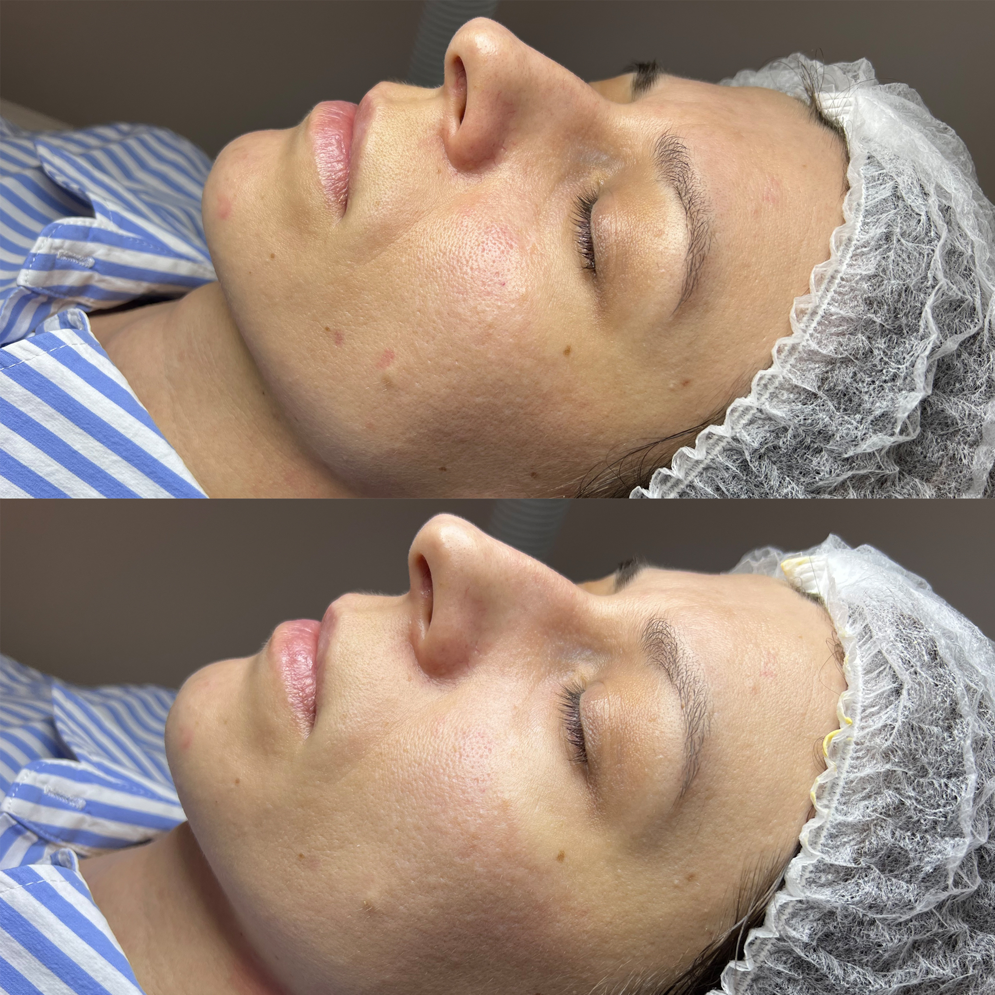 Oczyszczanie Wodorowe Efekty 10