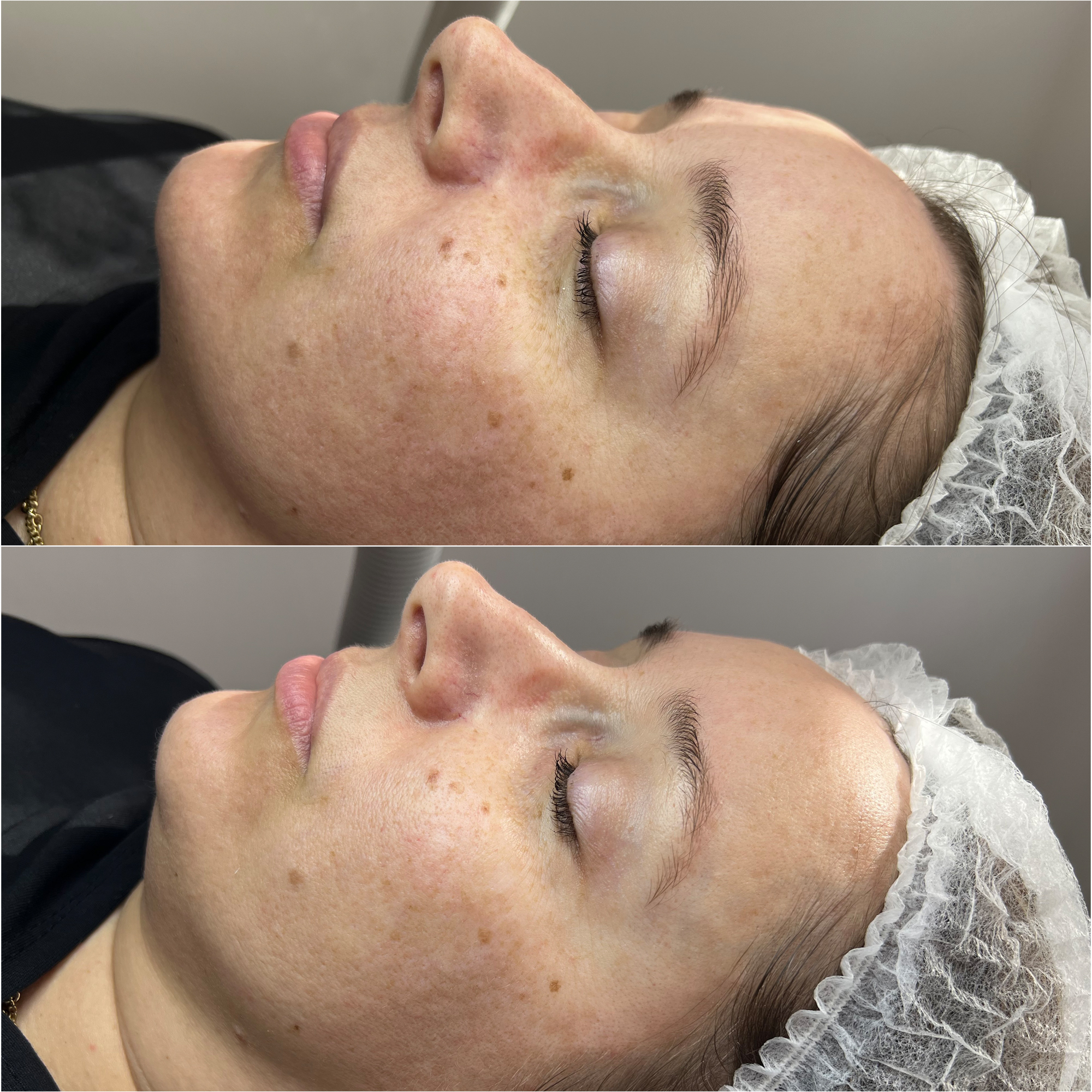 Oczyszczanie Wodorowe Efekty 11