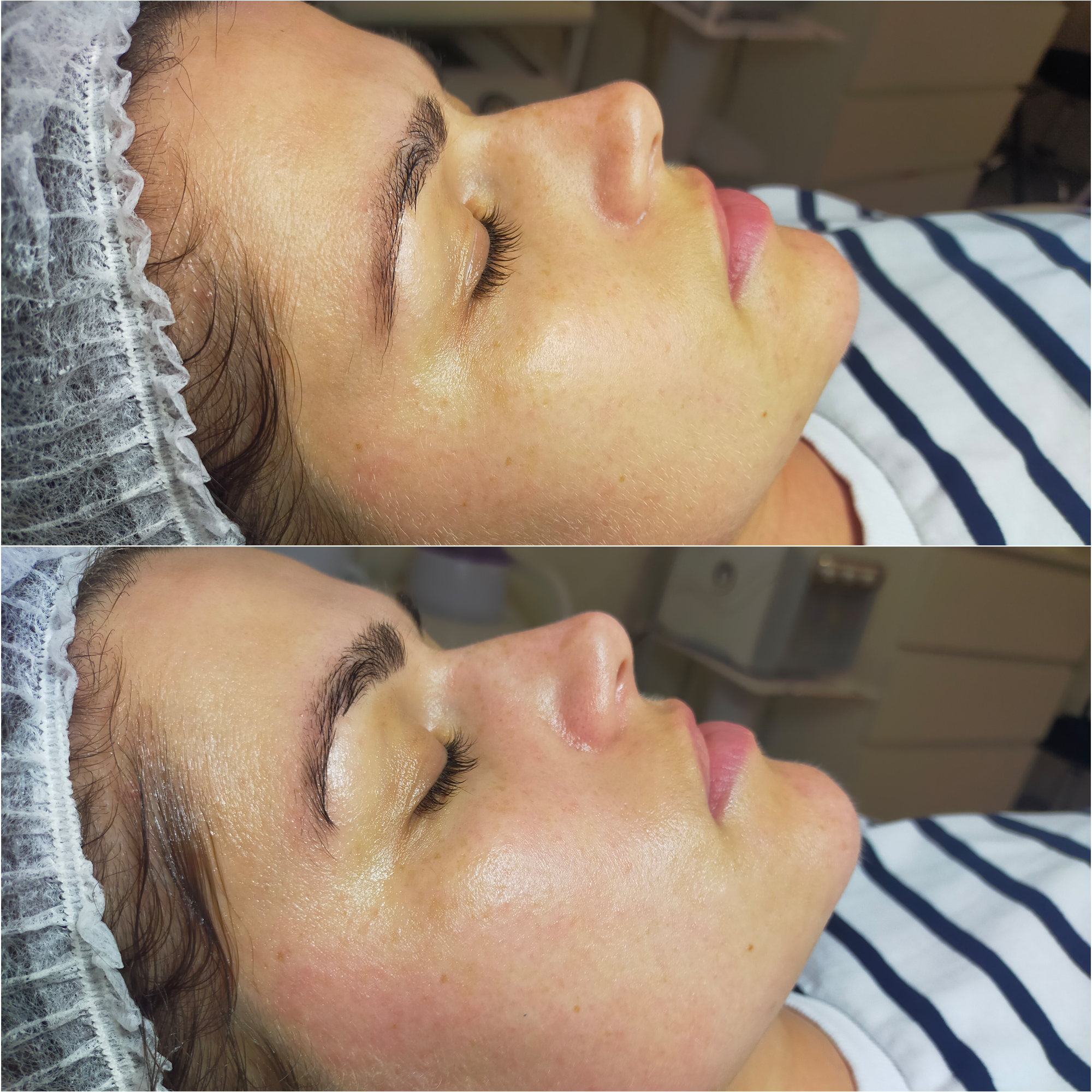 Oczyszczanie Wodorowe Efekty 12