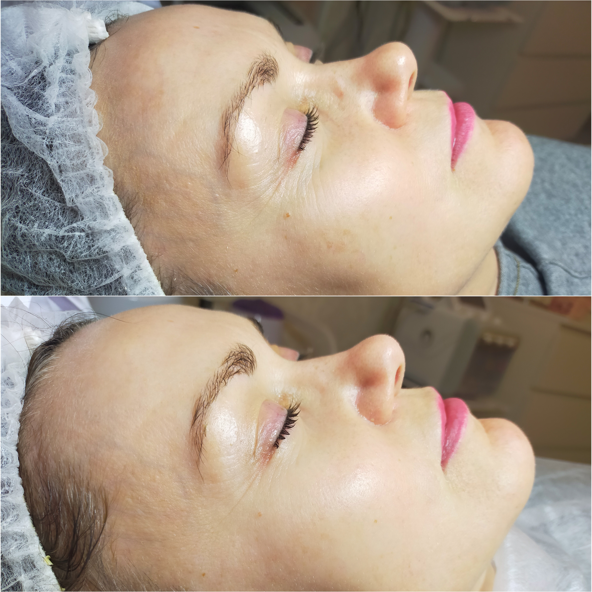 Oczyszczanie Wodorowe Efekty 13