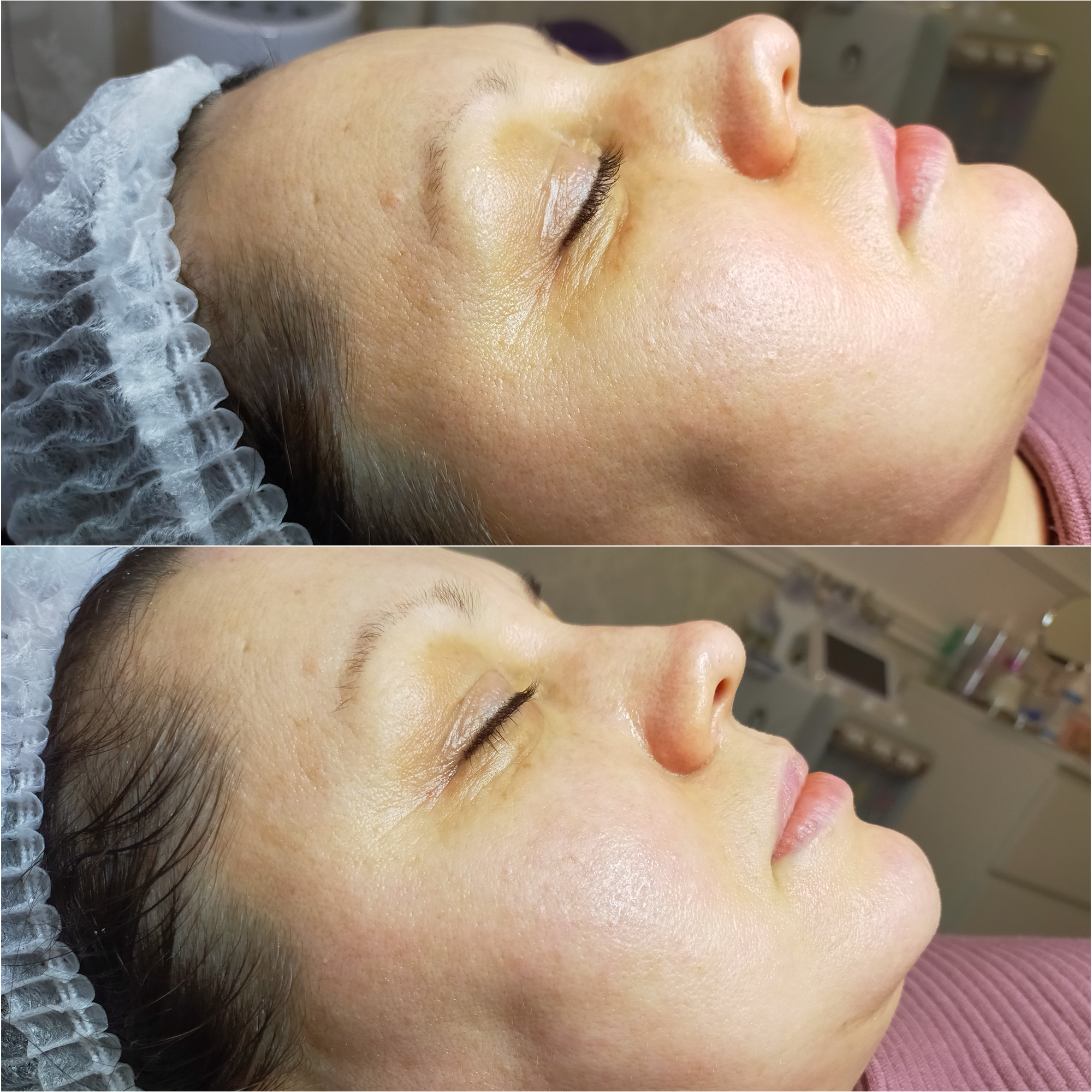 Oczyszczanie Wodorowe Efekty 14