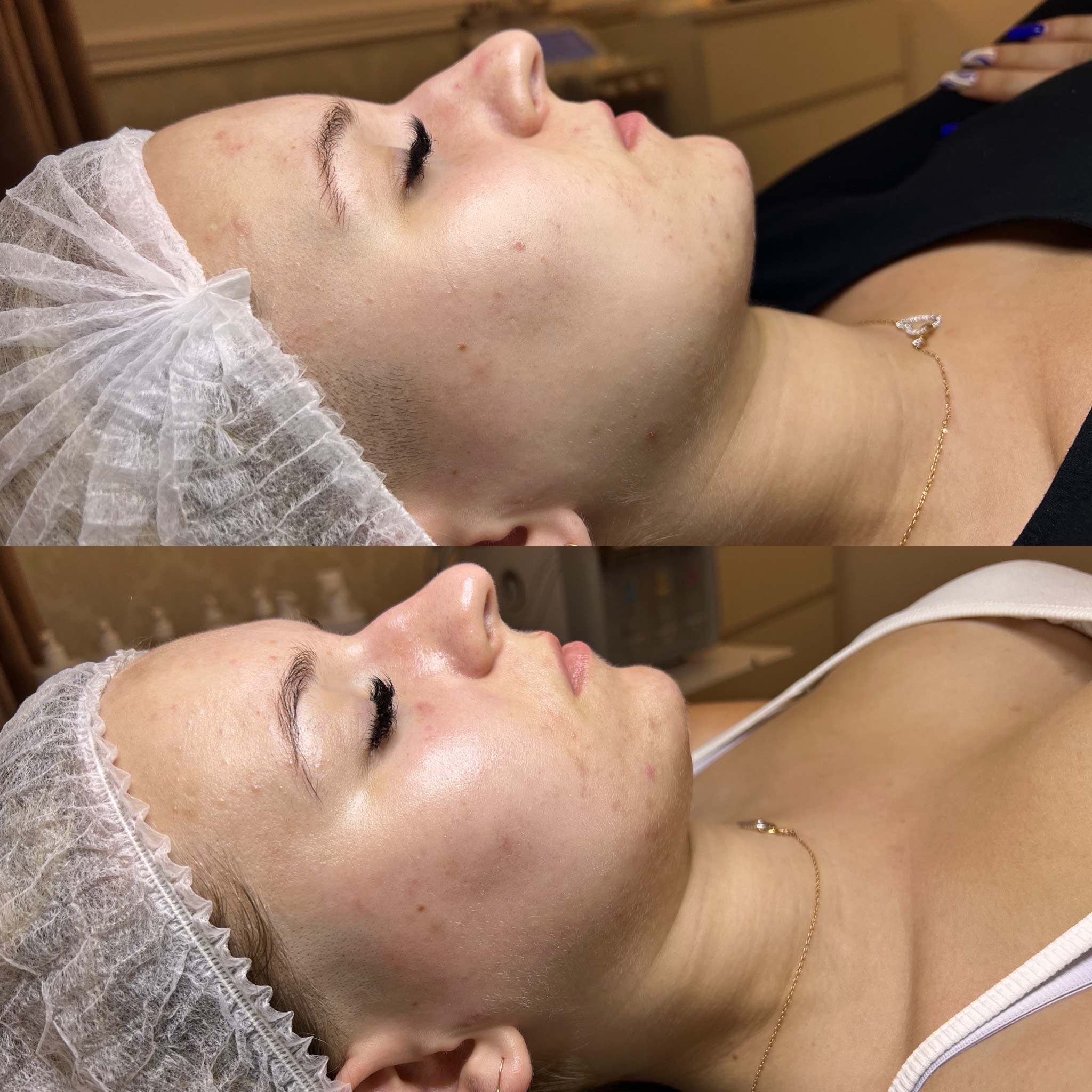 Oczyszczanie Wodorowe Efekty 15