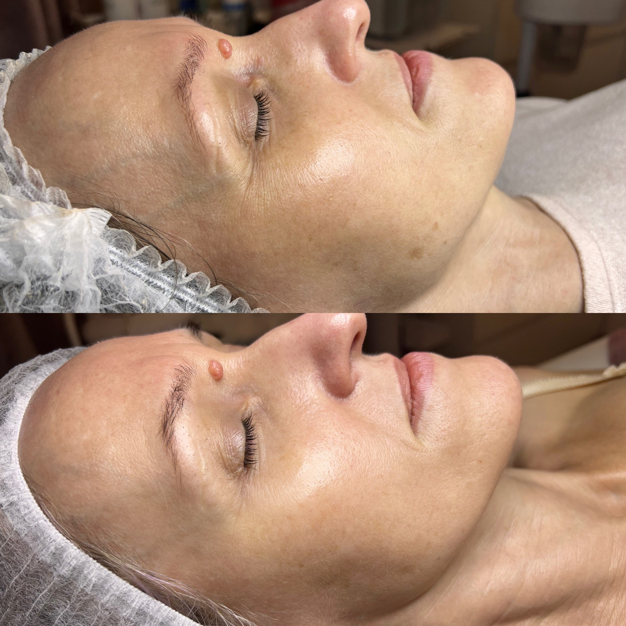 Oczyszczanie Wodorowe Efekty 16