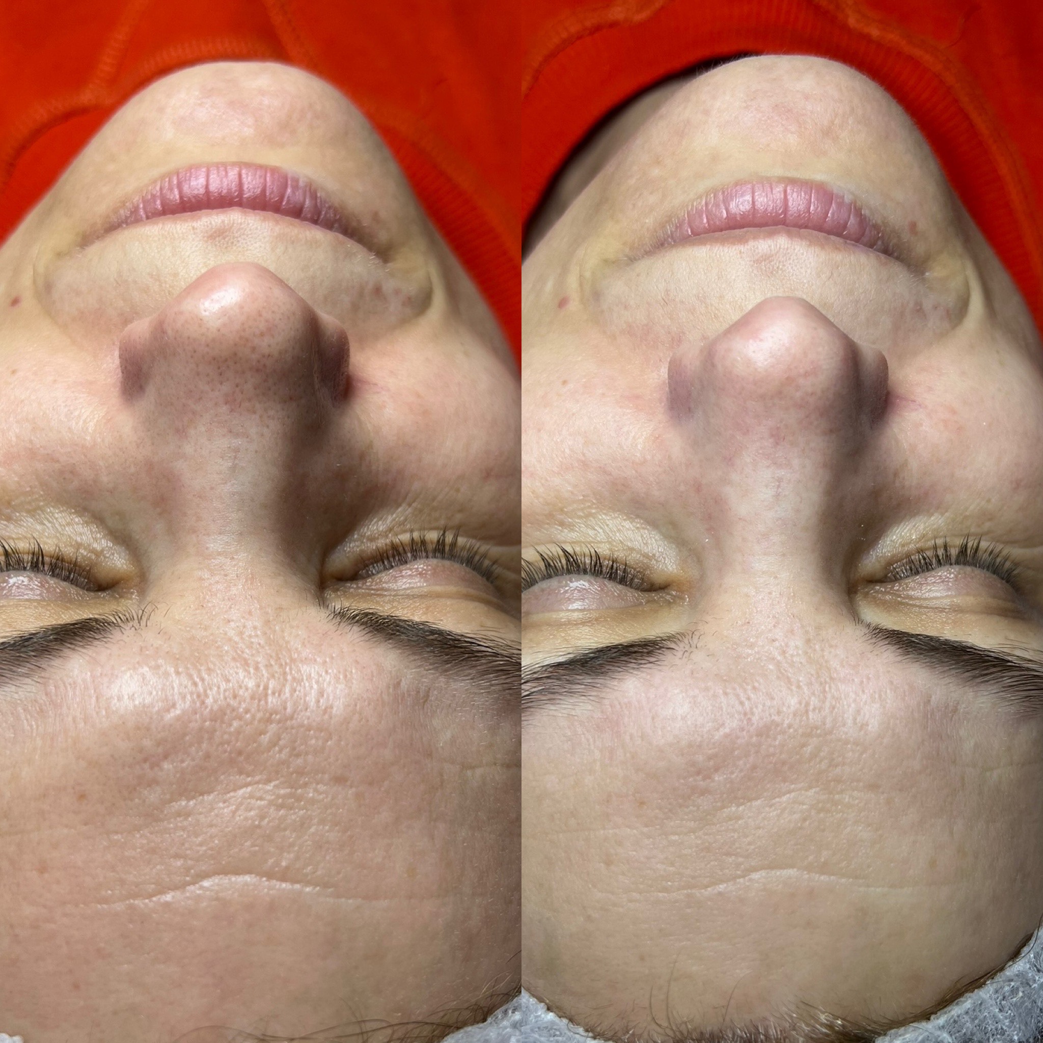 Oczyszczanie Wodorowe Efekty 18