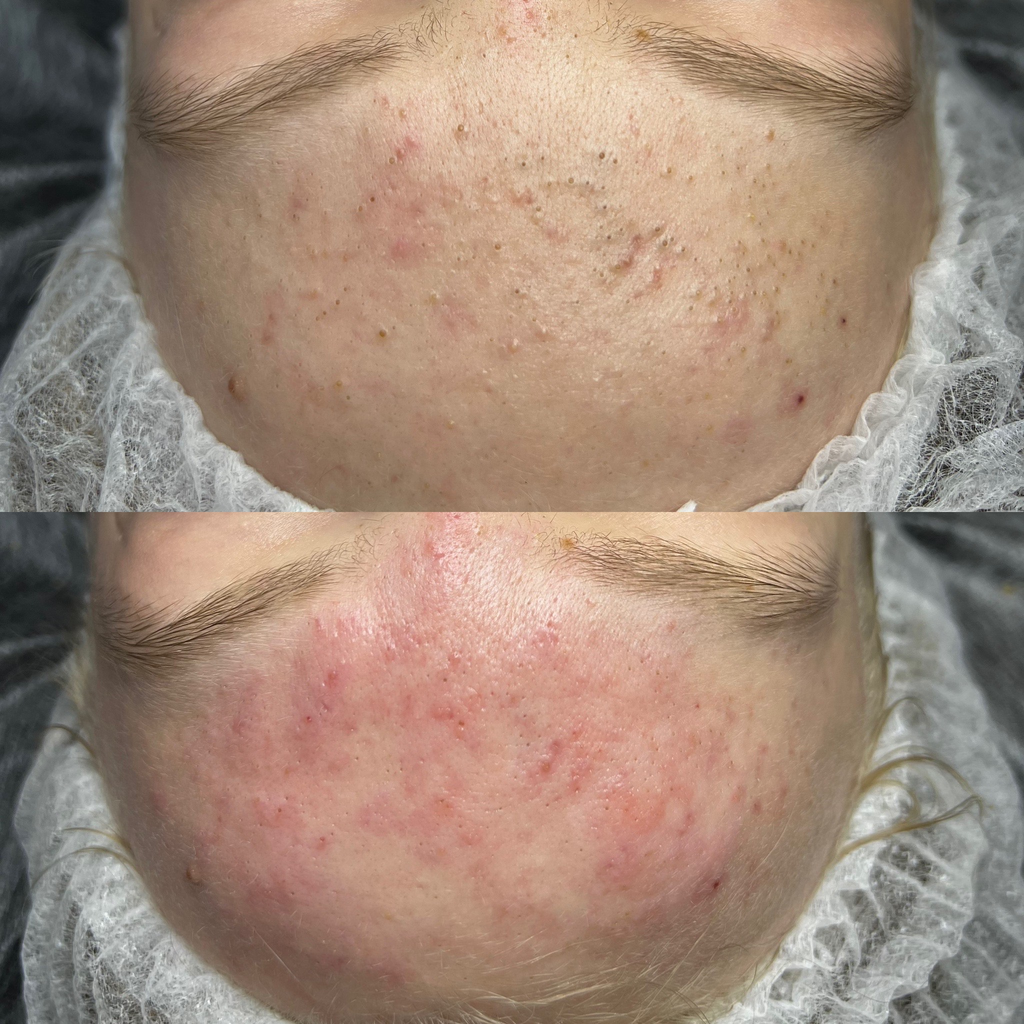 Oczyszczanie Wodorowe Efekty 19