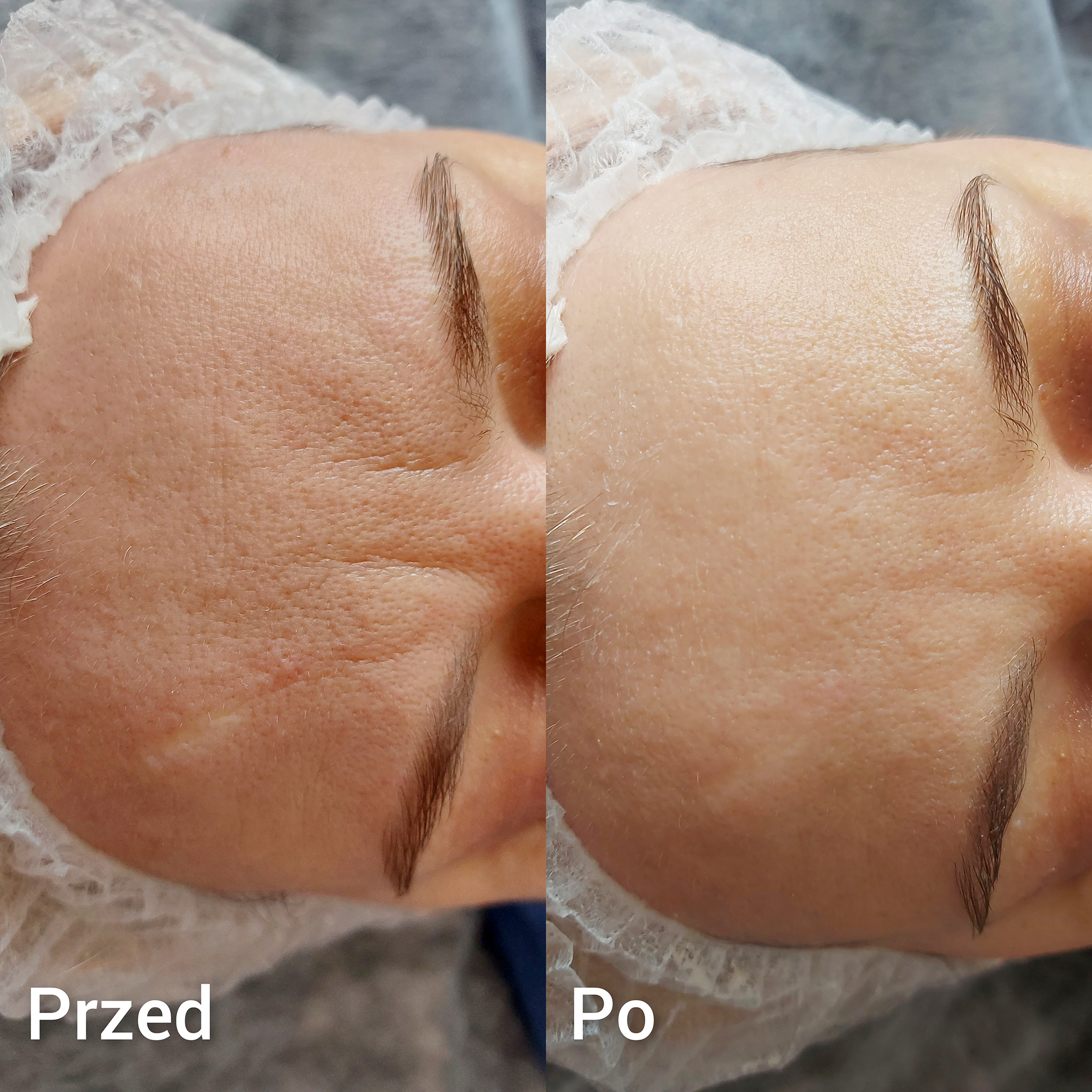 Oczyszczanie Wodorowe Efekty 2