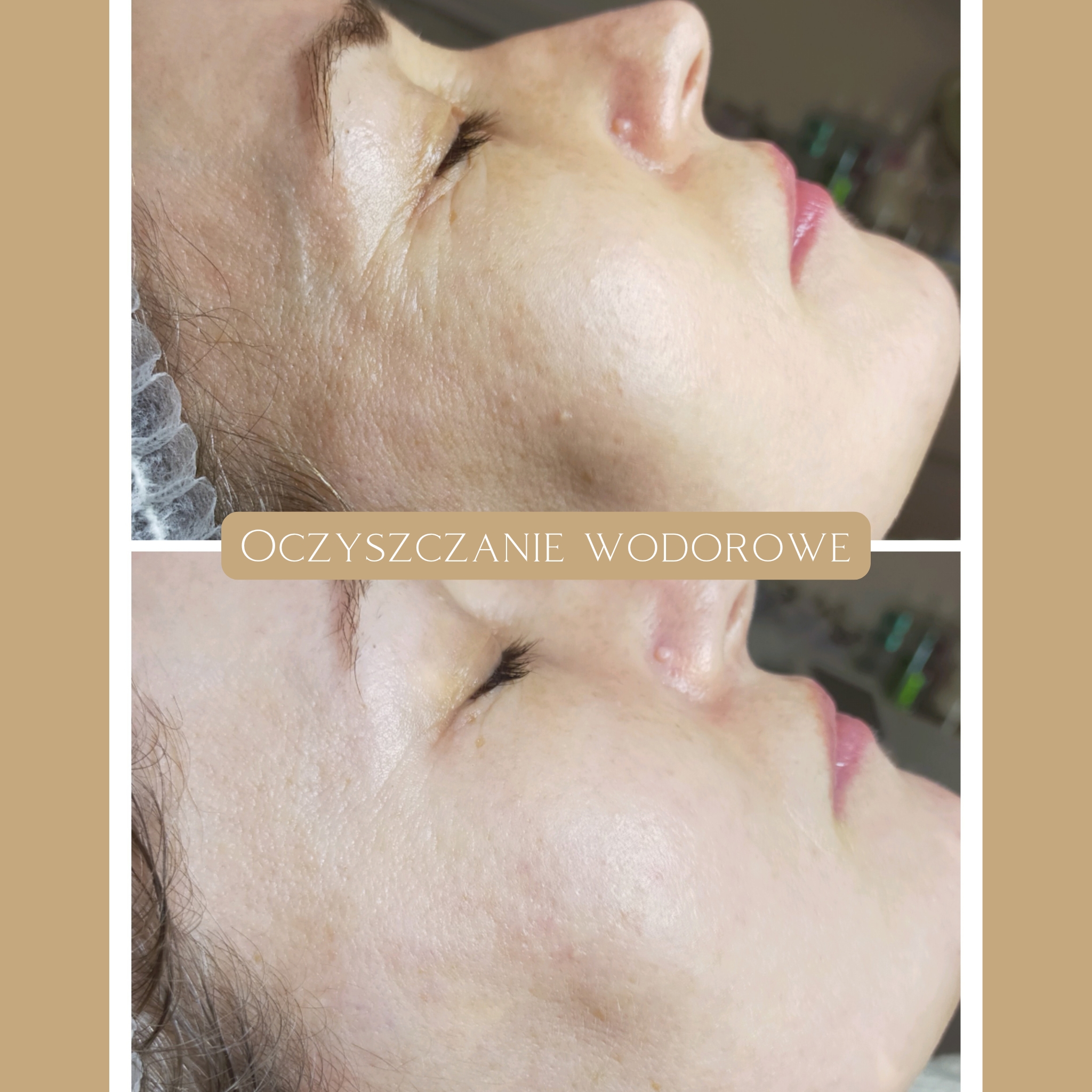 Oczyszczanie Wodorowe Efekty 22