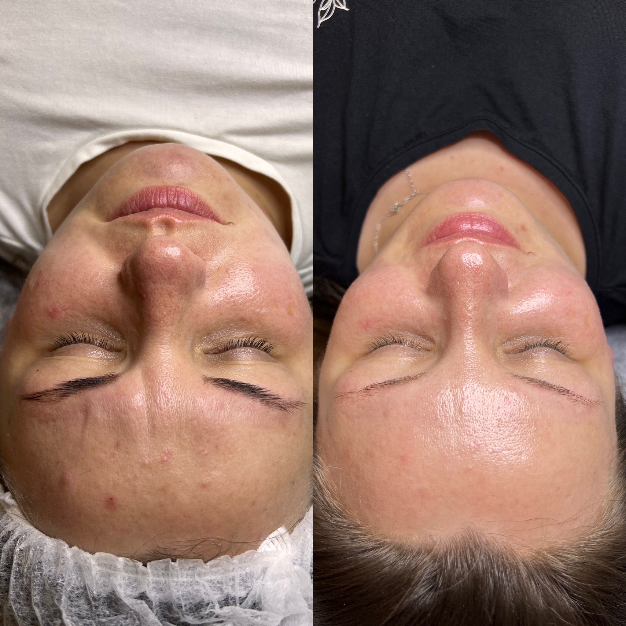 Oczyszczanie Wodorowe Efekty 4