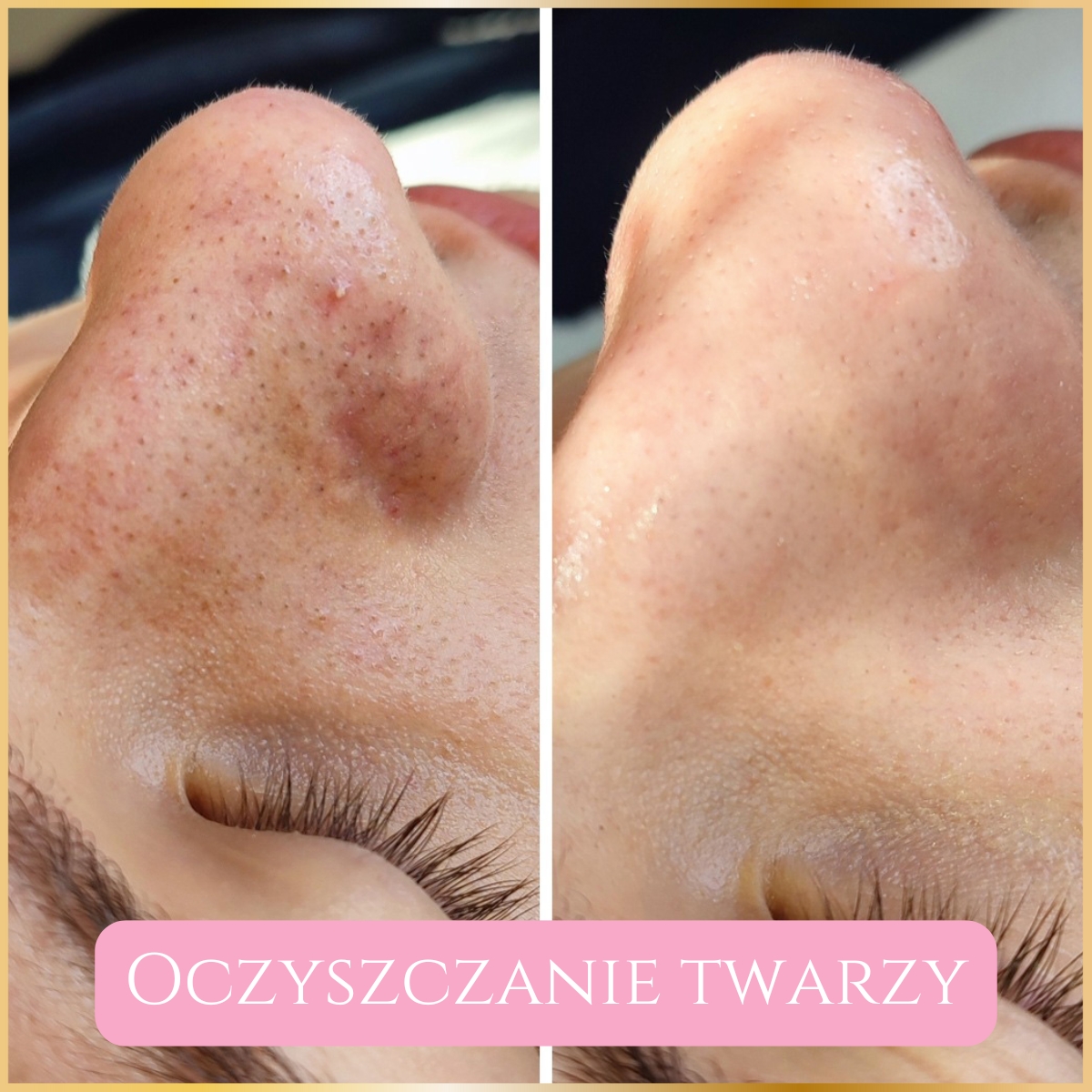 Oczyszczanie Wodorowe Efekty 6