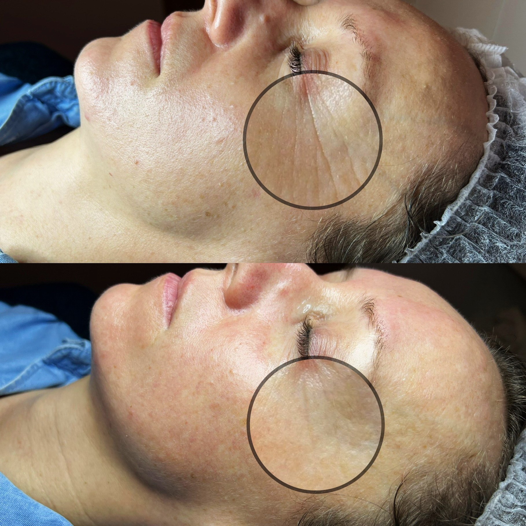 Oczyszczanie Wodorowe Efekty 7