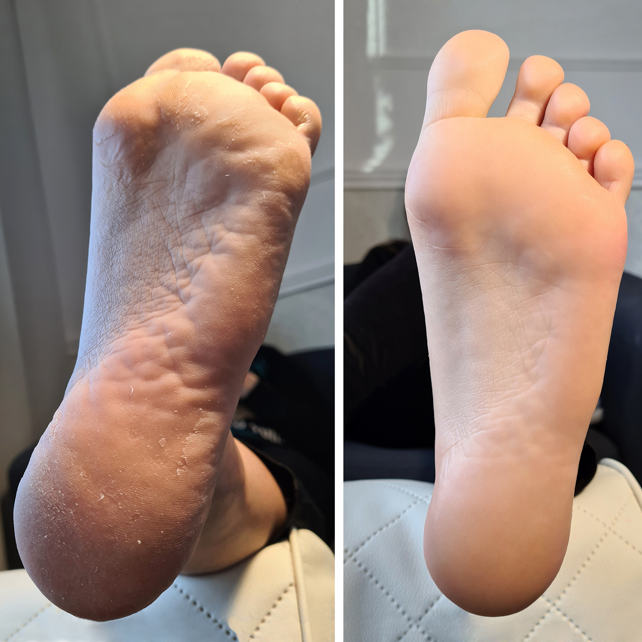 Pedicure Kwasowy Efekty 1