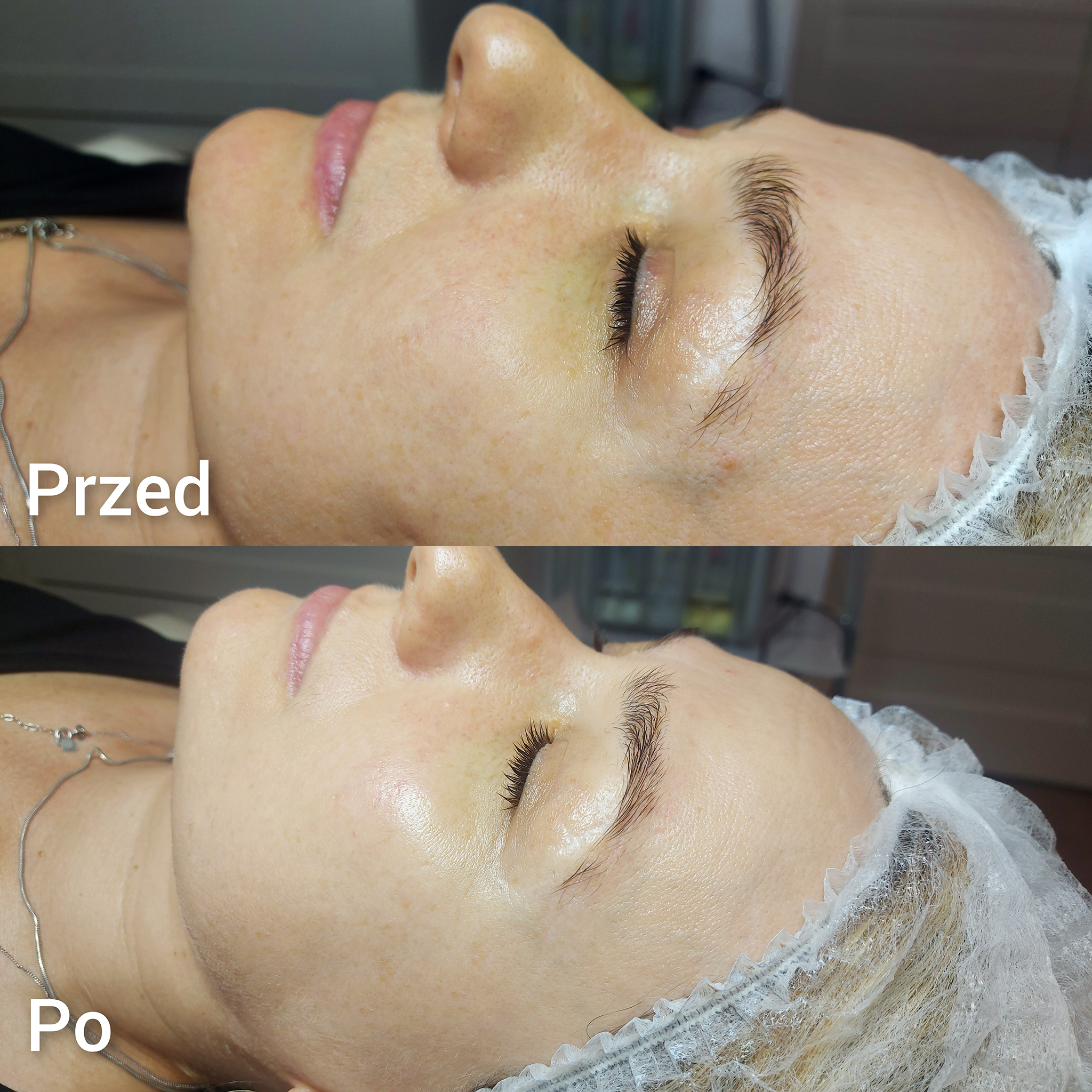 Peeling Kawitacyjny Efekty 2