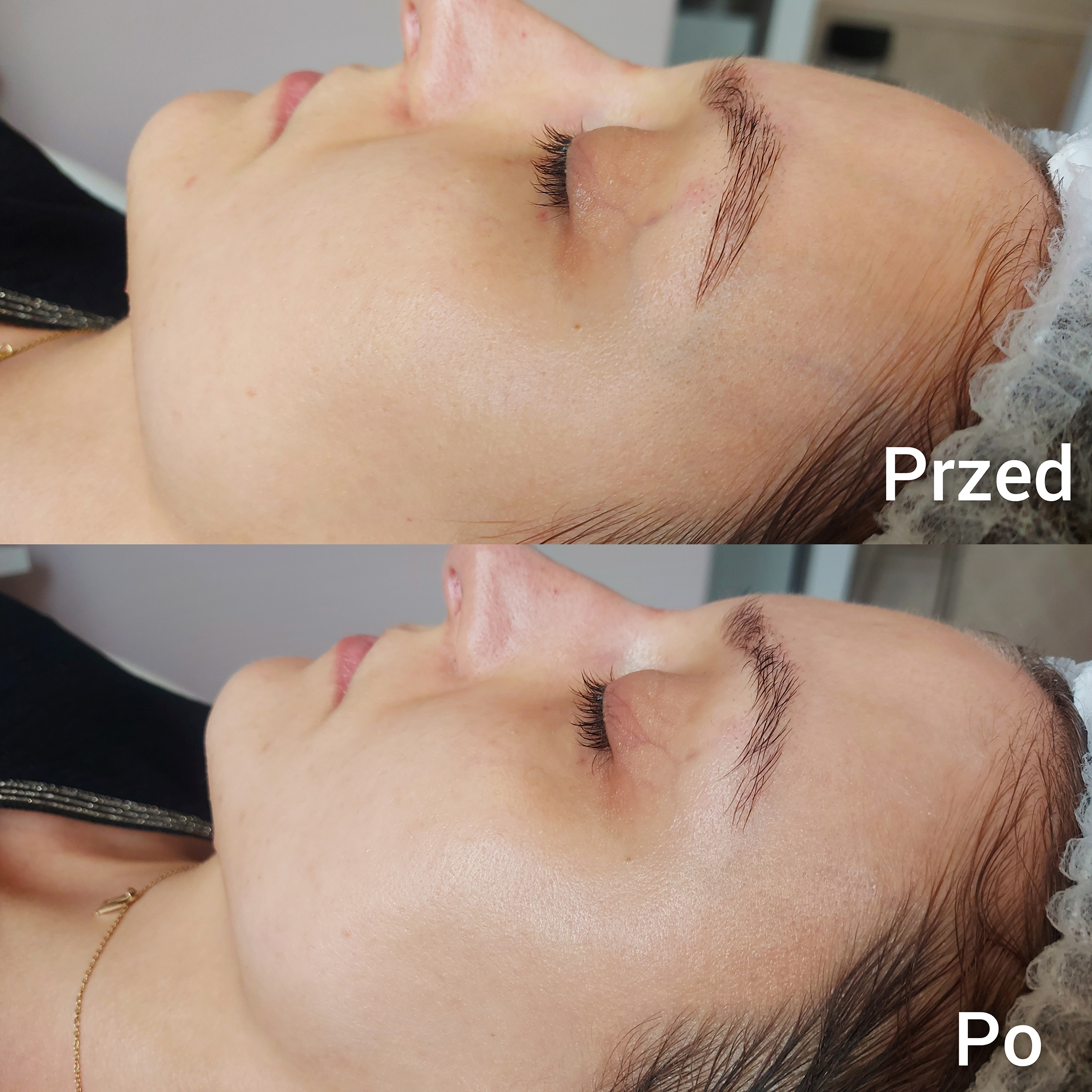 Peeling Kawitacyjny Efekty 4