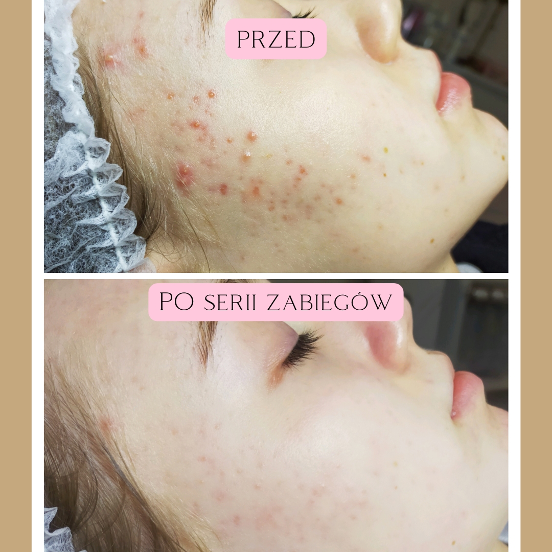 Sebo Purity Efekty 1