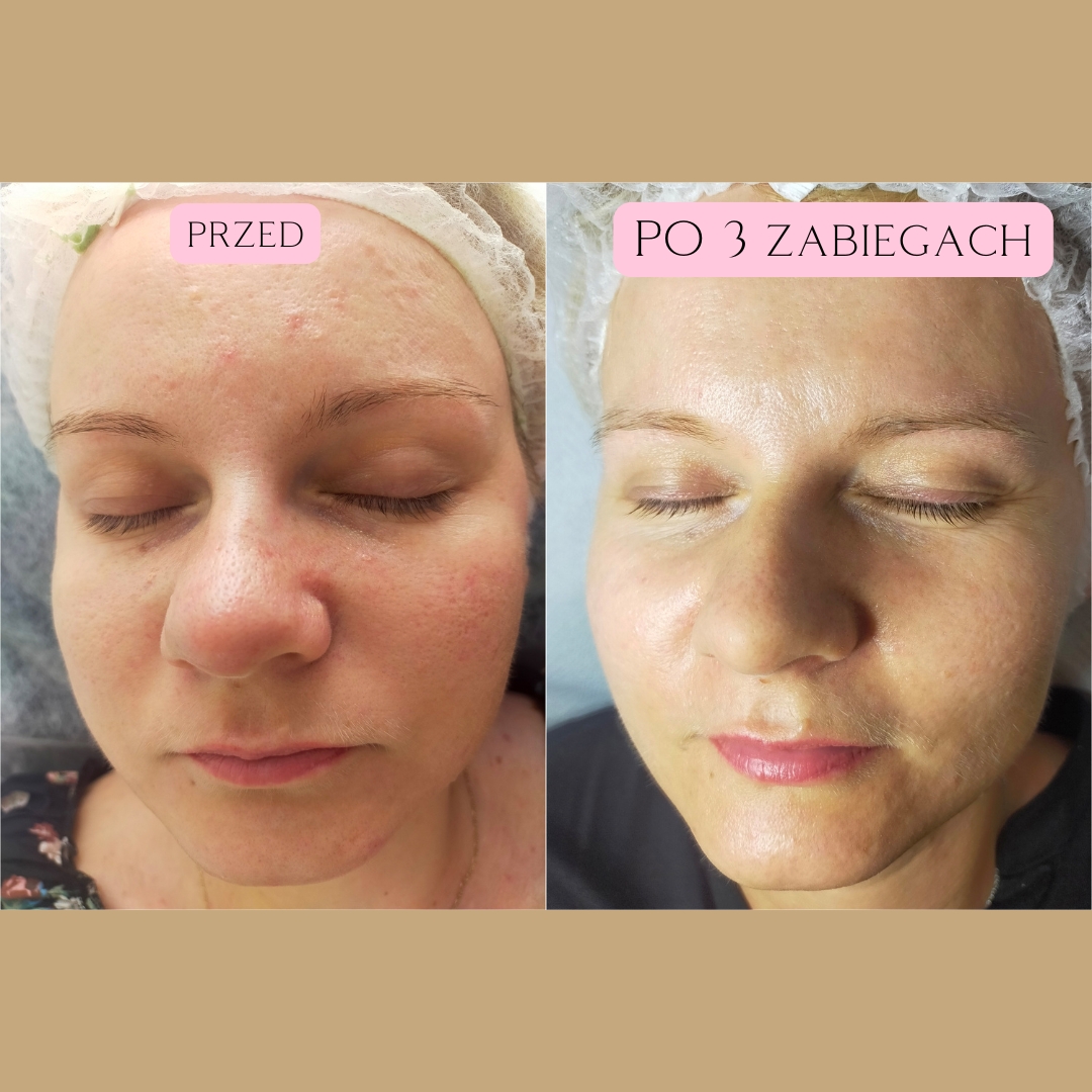 Sebo Purity Efekty 5