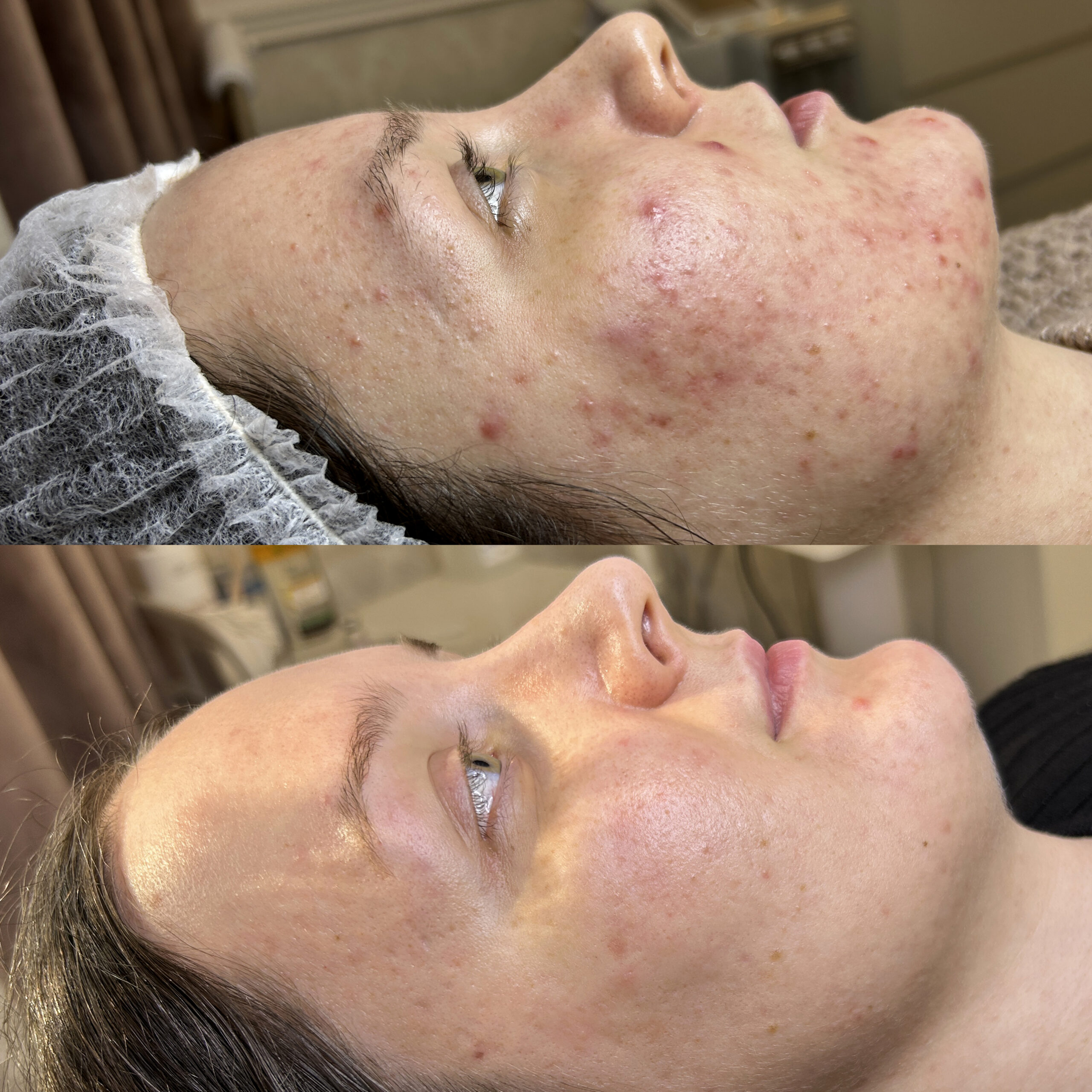 Terapia Nanili Przed i po